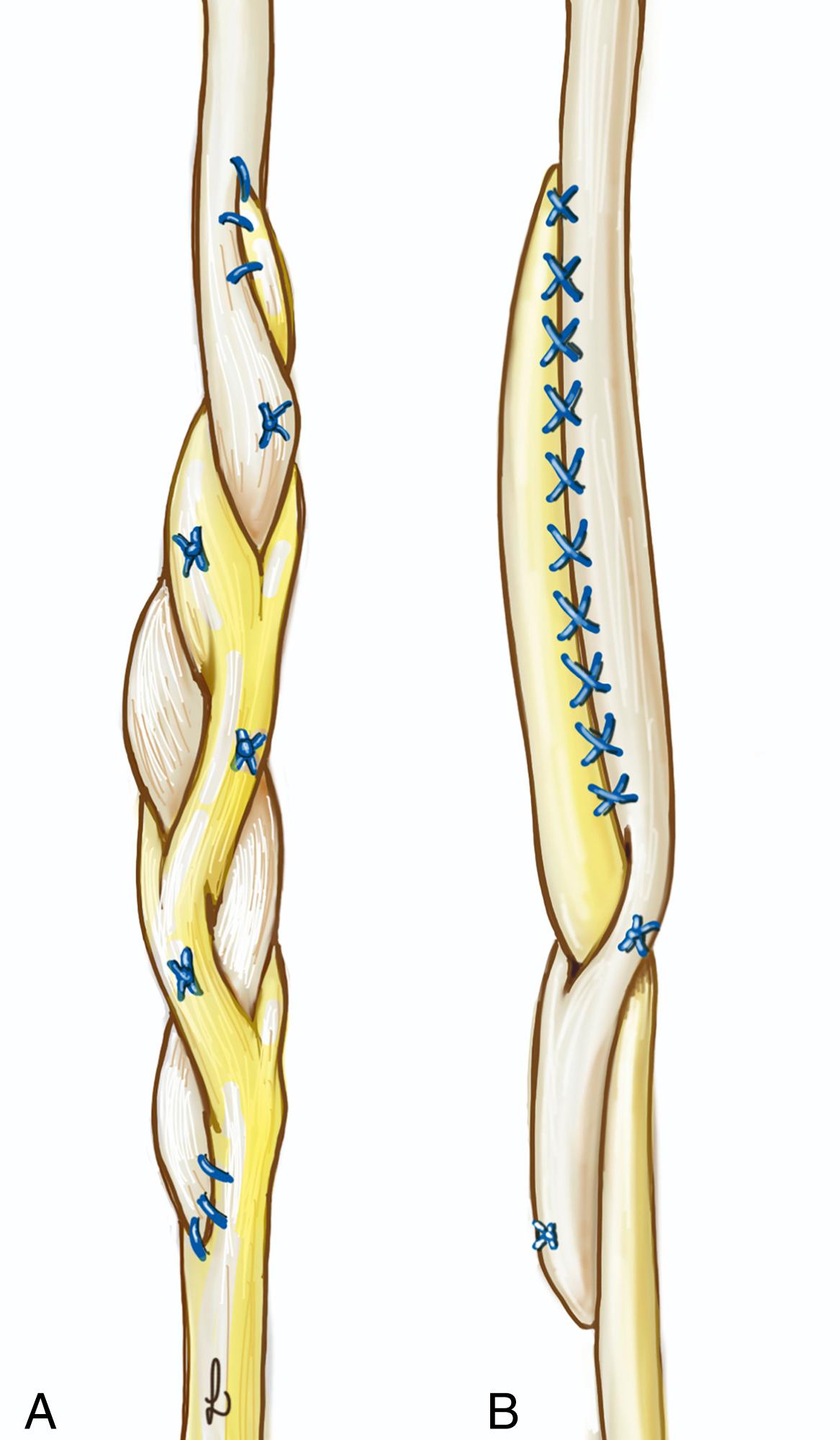 Fig. 55.10, Tendon reconstruction technique according to Pulvertaft (A) and Friden (B) .