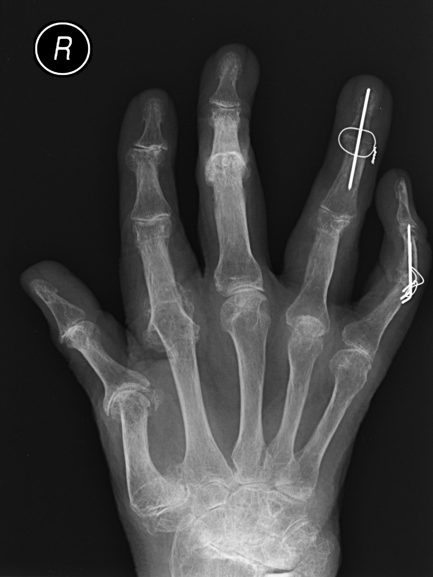 Fig. 59.1, Various rheumatoid deformities of the hand including a swan neck deformity of thumb, subluxation of the index metacarpophalangeal joint (MCPJ), and generalized arthritic change throughout the hand and wrist. Note fusion of distal interphalangeal joint (DIPJ) of the ring and proximal interphalangeal joint (PIPJ) of the little fingers.