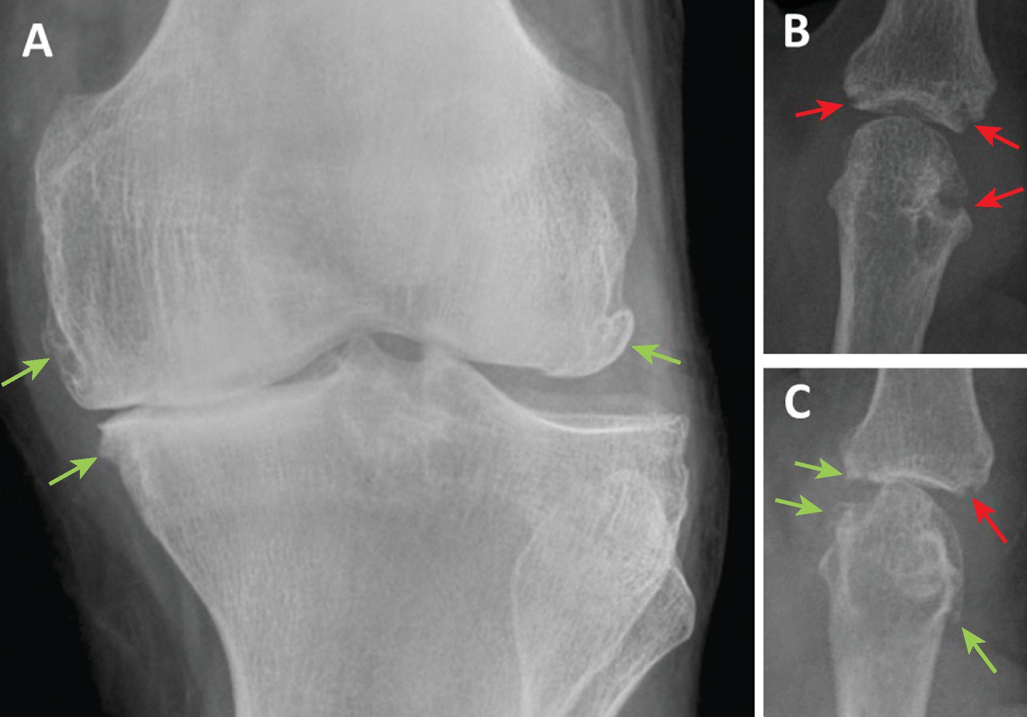 Figure 46.1, Radiographic change in osteoarthritis and rheumatoid arthritis. (A) Posteroanterior radiograph of the knee of a person with structural changes of tibiofemoral osteoarthritis. The lateral joint compartment can be identified by the localization of the fibula. The medial tibiofemoral joint space is narrowed, with marginal osteophytes ( green arrows ) and subchondral sclerosis. (B and C) Plain radiographs of second metacarpophalangeal joints of two people with rheumatoid arthritis. B shows erosive damage ( red arrows ) at joint margins. C displays erosive change also, and more severe joint space narrowing plus marginal osteophytes. It is not possible from plain radiographs to determine whether the individuals concerned were experiencing pain, nor how severe any pain was. The osteoarthritic changes in C may represent comorbid osteoarthritis that preceded the onset of rheumatoid arthritis or may show secondary osteoarthritis following earlier erosive damage. Disease modifying treatments may reduce the progression of erosive damage in rheumatoid arthritis but do not always eliminate pain.