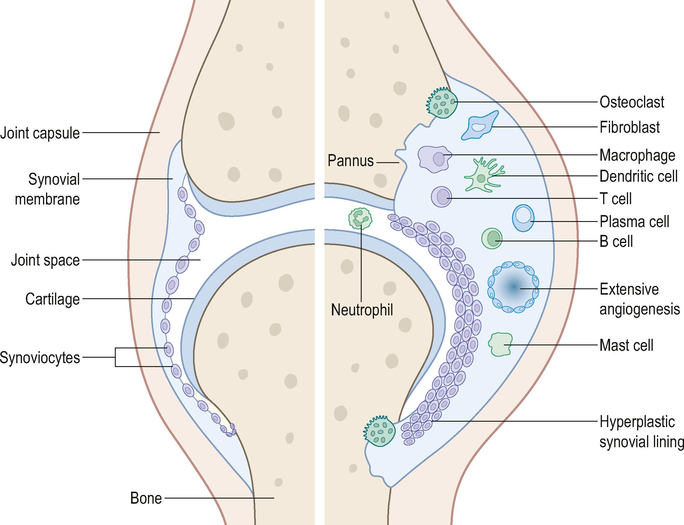 Figure 19.1, The erosive synovial pannus consists of hypertrophic synovium and inflammatory cells.