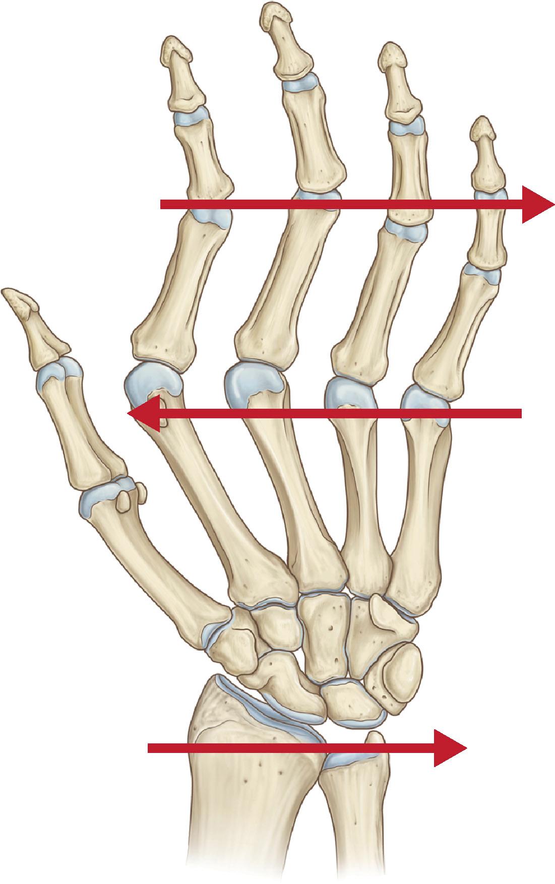 Figure 19.16, Radial deviation and ulnar translocation at the wrist contribute to ulnar deviation at the MCP joints.