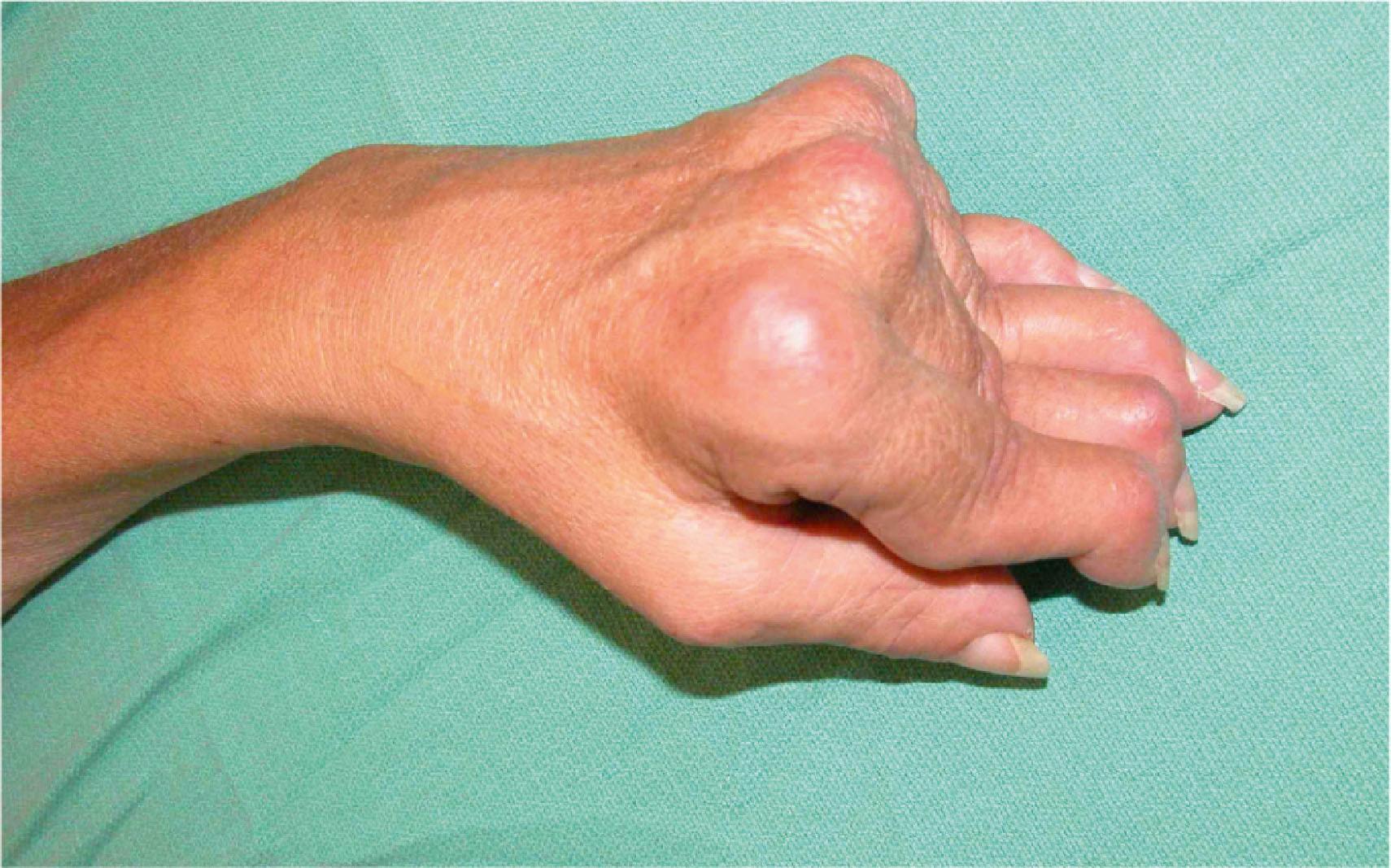 Figure 19.18, Classic swan-neck deformities of all fingers, with MCP flexion, PIP hyperextension, and DIP flexion.