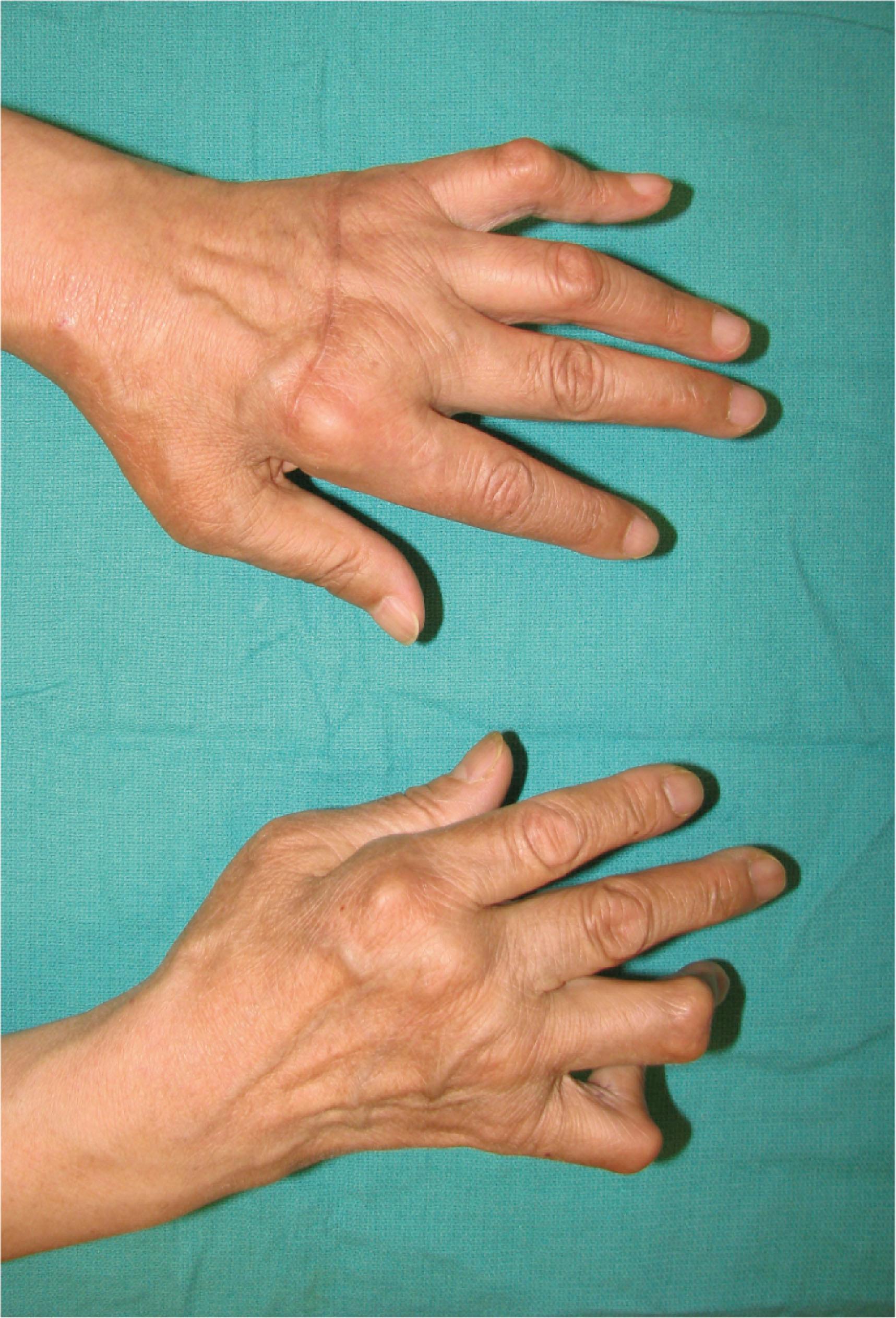 Figure 19.19, Boutonnière deformity of the right ring and small fingers, and left small finger. Left ring finger demonstrates very early boutonnière deformity.