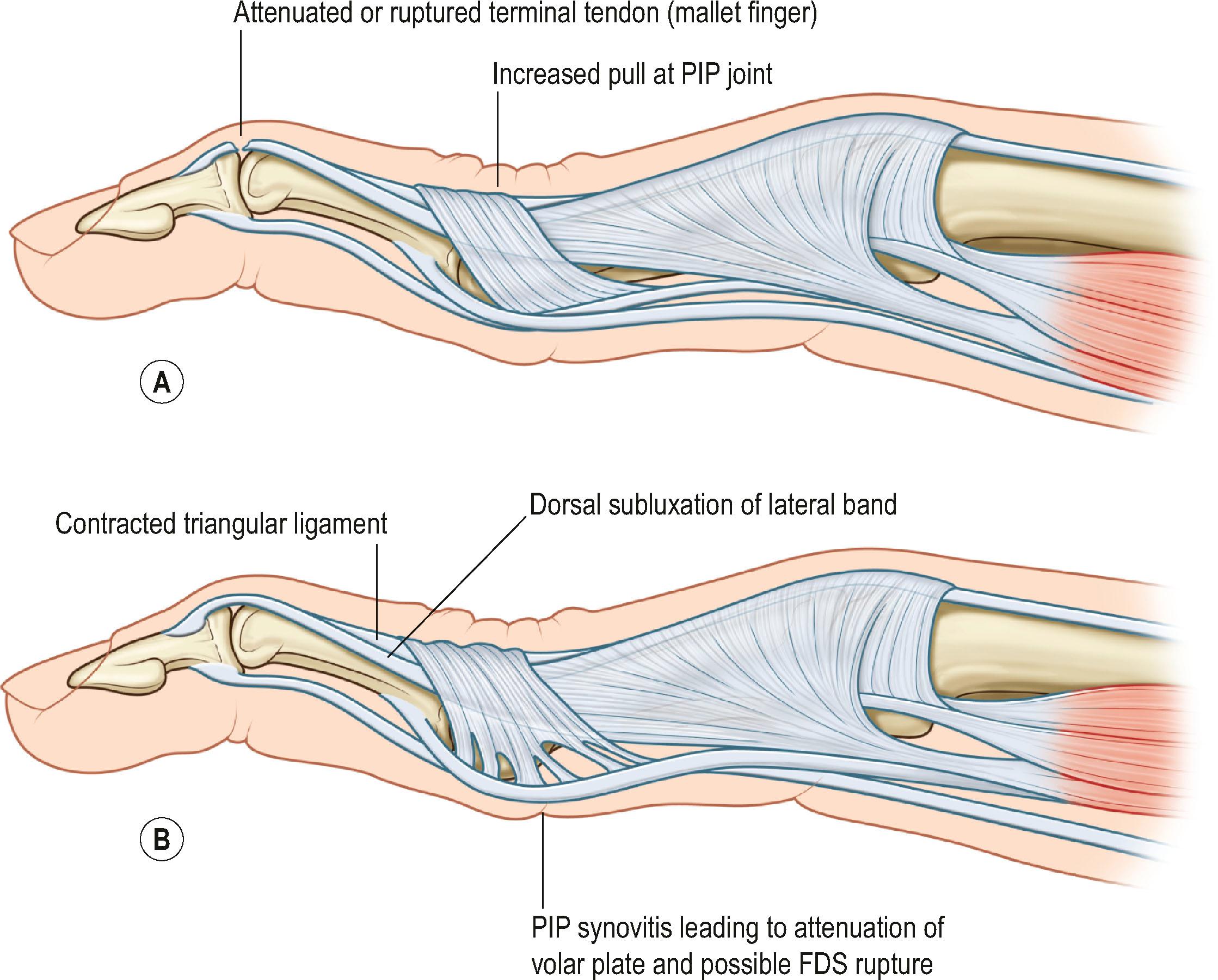 Figure 19.20, (A) Swan-neck deformity originating from a mallet finger, with subsequent increased extension force at the PIP joint. (B) Swan-neck deformity originating at the PIP joint, with volar plate attenuation and possible FDS rupture due to PIP synovitis, and subsequent dorsal subluxation of the lateral bands.