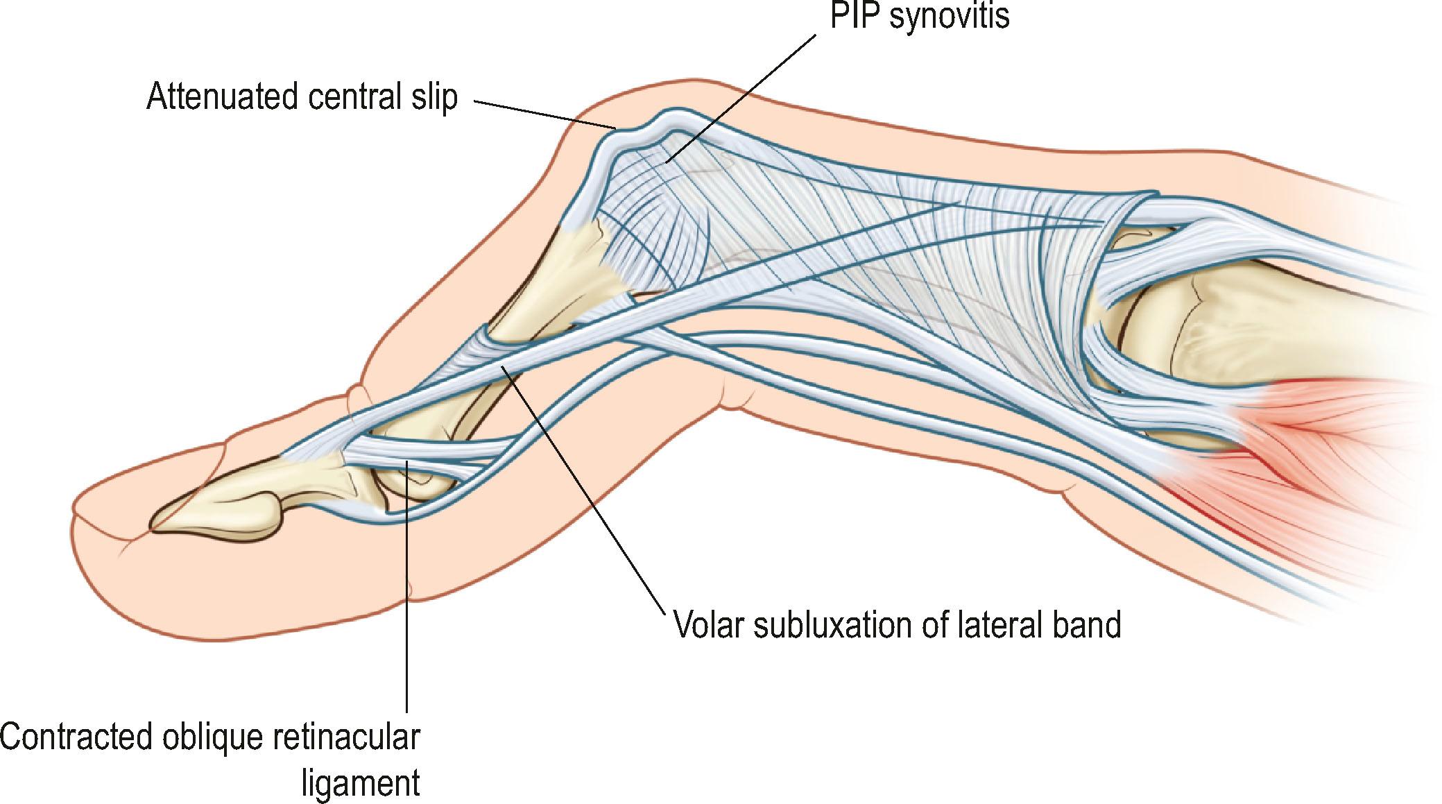 Figure 19.21, Boutonnière deformity secondary to synovitis at the PIP joint, with attenuation of the central slip, and subsequent volar subluxation of the lateral bands.