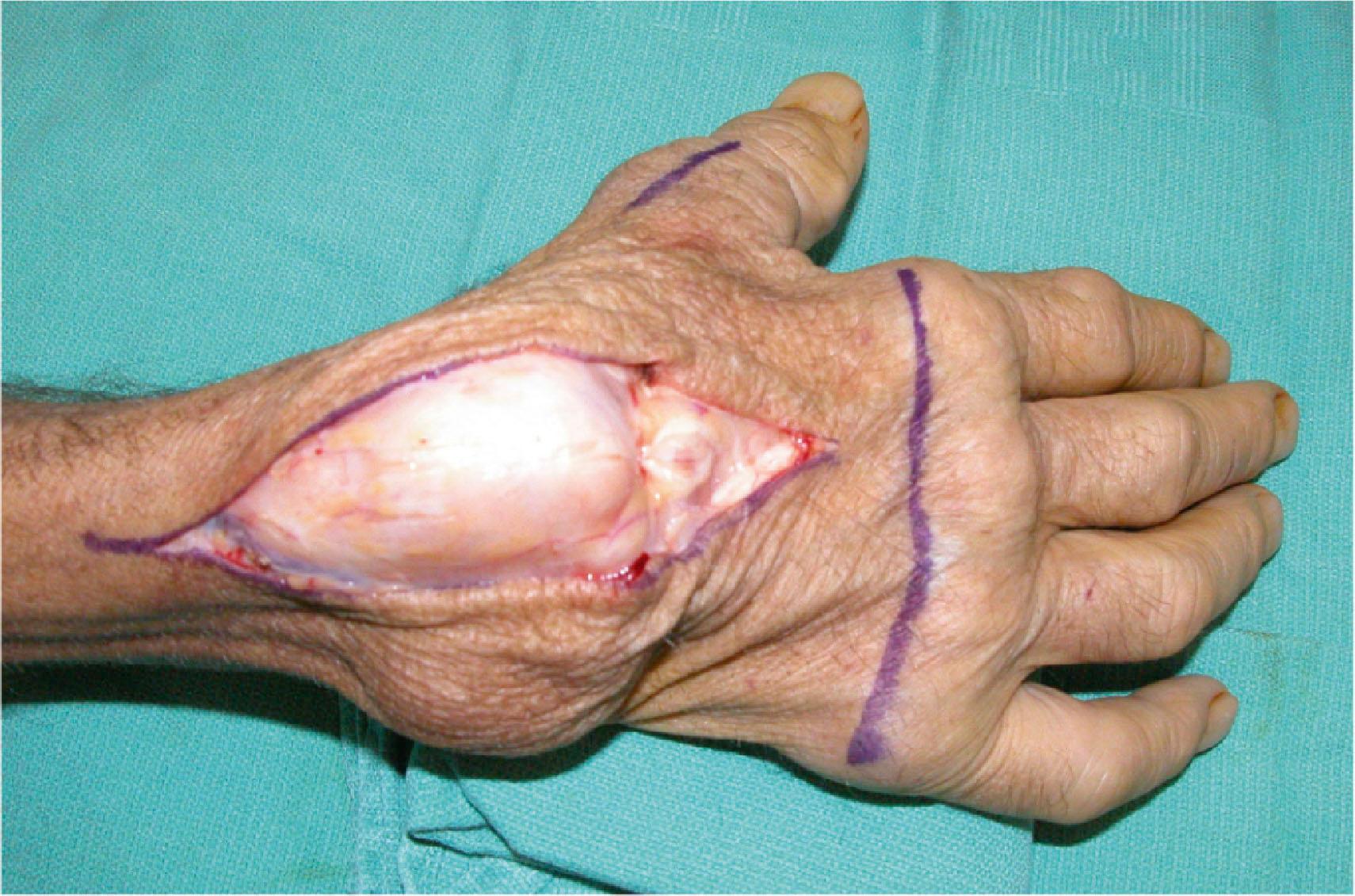 Figure 19.23, Extensor tenosynovitis of the right wrist, with severely attenuated extensor retinaculum.