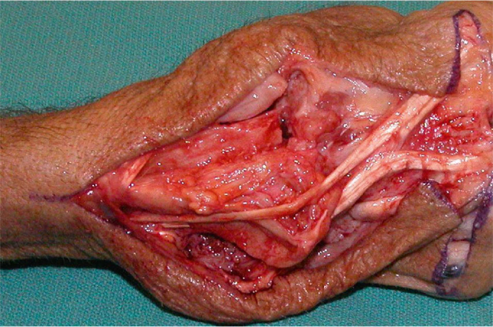 Figure 19.24, The extensor tenosynovitis has been partially removed. Note the redundancy of the extensor tendons, which have been stretched by the long-standing tenosynovitis.