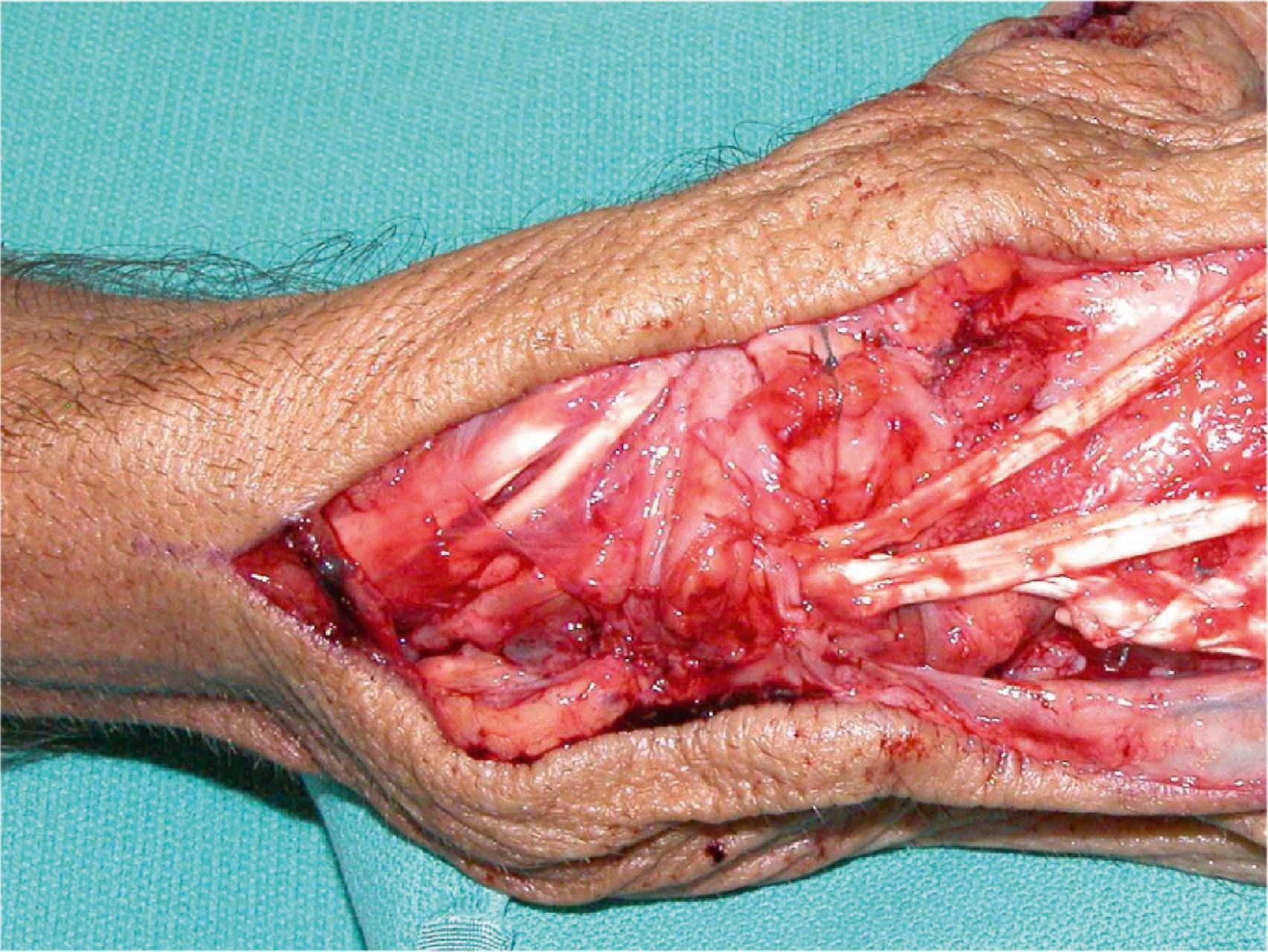 Figure 19.25, One retinacular flap (the distal half of the retinaculum) has been placed deep to the extensor tendons to protect them from rough bony surfaces. The other flap (the proximal half of the retinaculum) has been sutured dorsal to the extensor tendons to prevent bow-stringing.