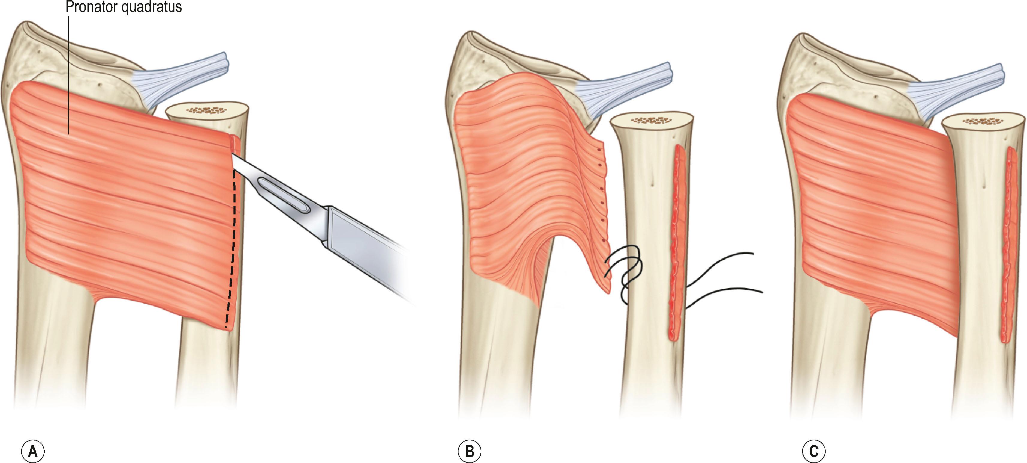 Figure 19.29, (A–C) The pronator quadratus is released from the volar aspect of the ulna, passed through the interosseous space, and sutured to the dorsal aspect of the ulna.