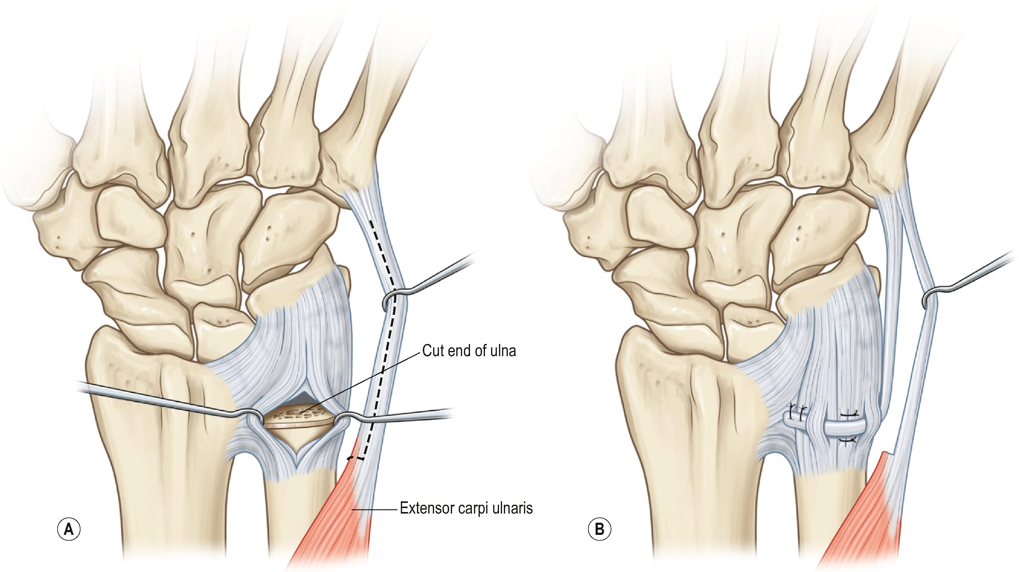 Figure 19.30, (A,B) Distally based slip of ECU is used to stabilize the ulnar stump.