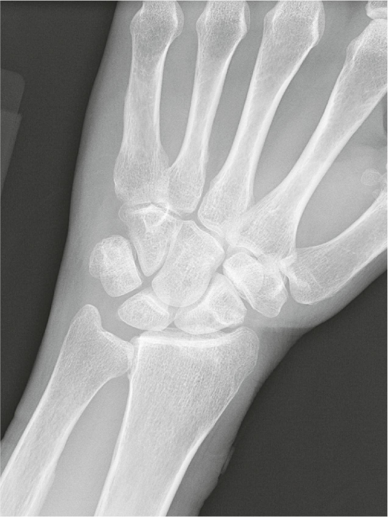 Figure 19.3, Posteroanterior (PA) radiograph of the left wrist, demonstrating early involvement of the DRUJ, as well as scattered carpal erosions from invasive synovitis.
