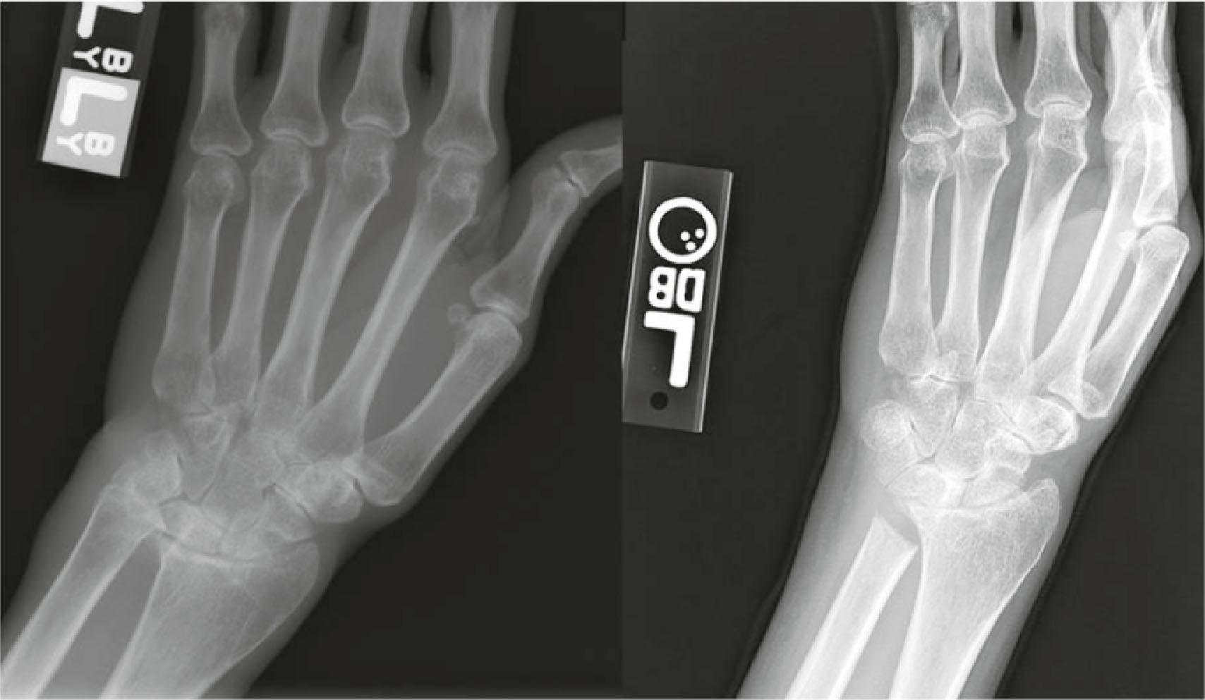 Figure 19.31, Pre- and postoperative radiographs demonstrating resection of the ulnar head.