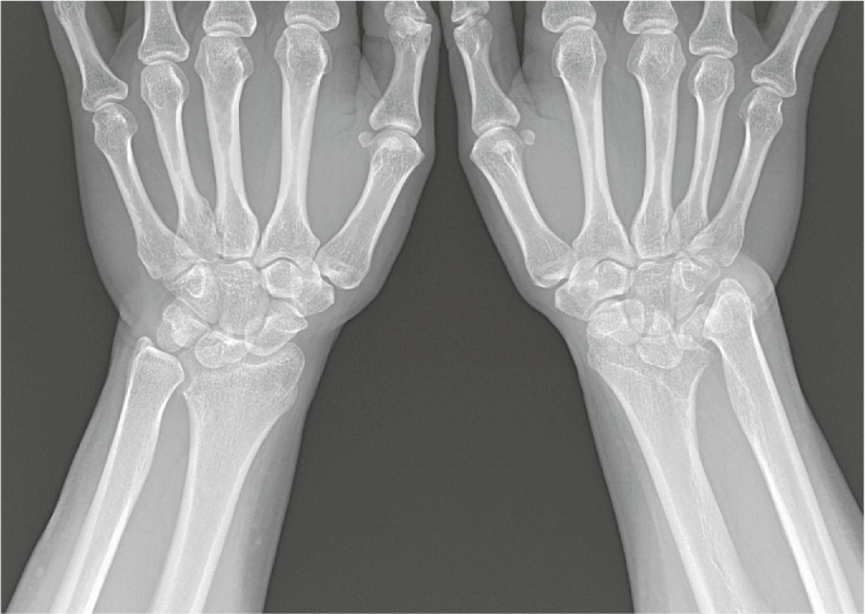 Figure 19.32, Bilateral wrist radiographs demonstrating severe involvement of the radiocarpal joint, and relative sparing of the mid-carpal joint.