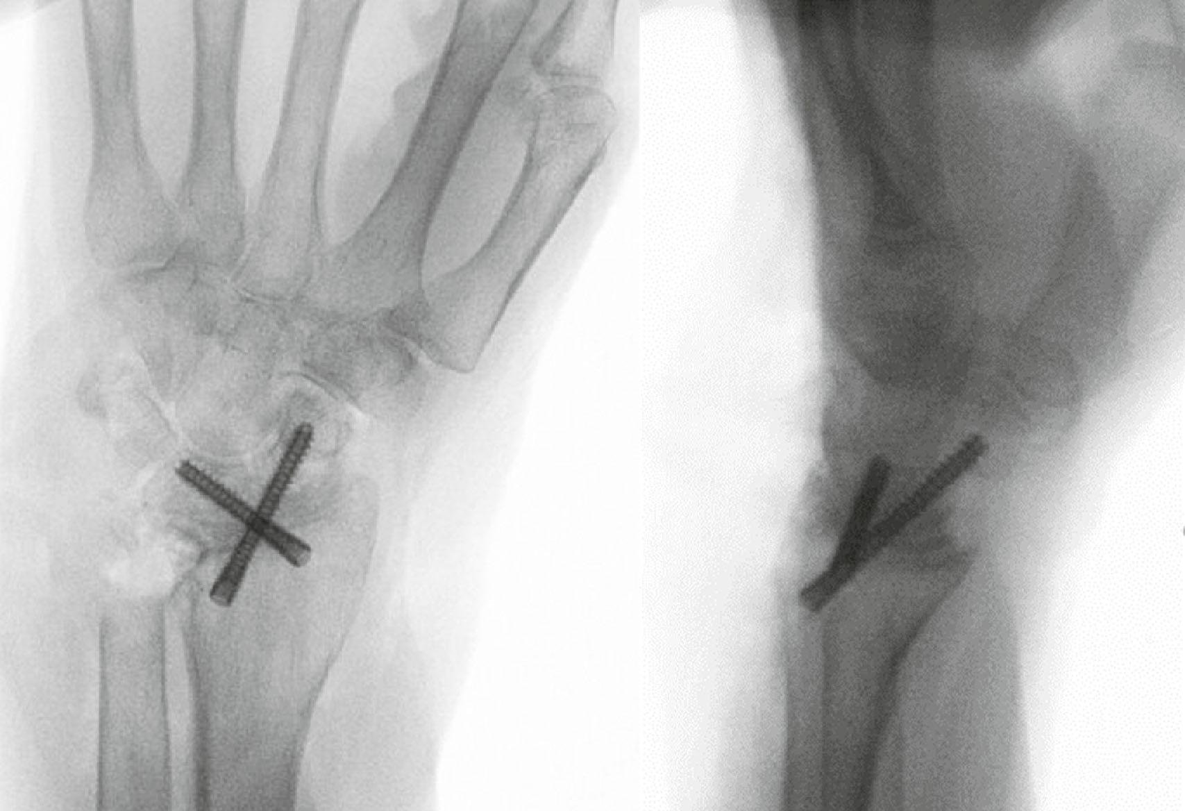 Figure 19.33, Radioscapholunate (RSL) arthrodesis, with compression screws.