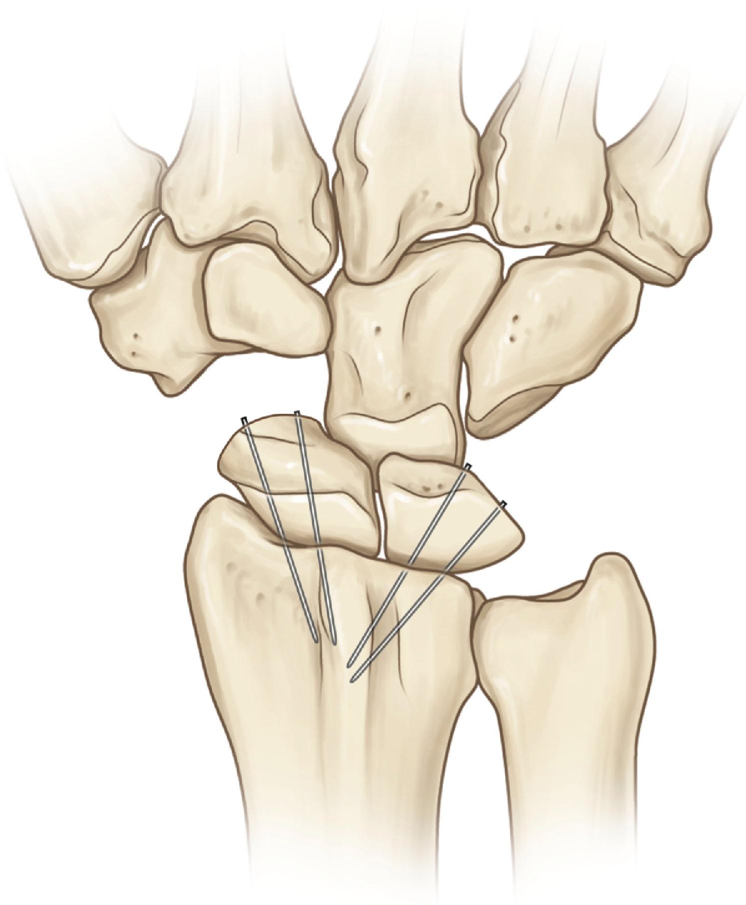 Figure 19.34, Radiocarpal arthrodesis with K-wires.