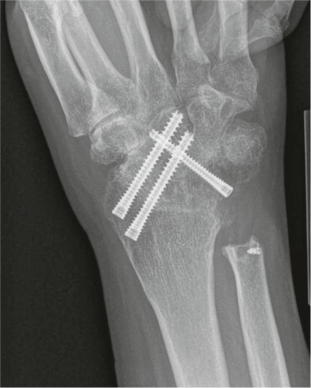 Figure 19.36, Wrist arthrodesis with headless compression screws in a patient with good bone quality.