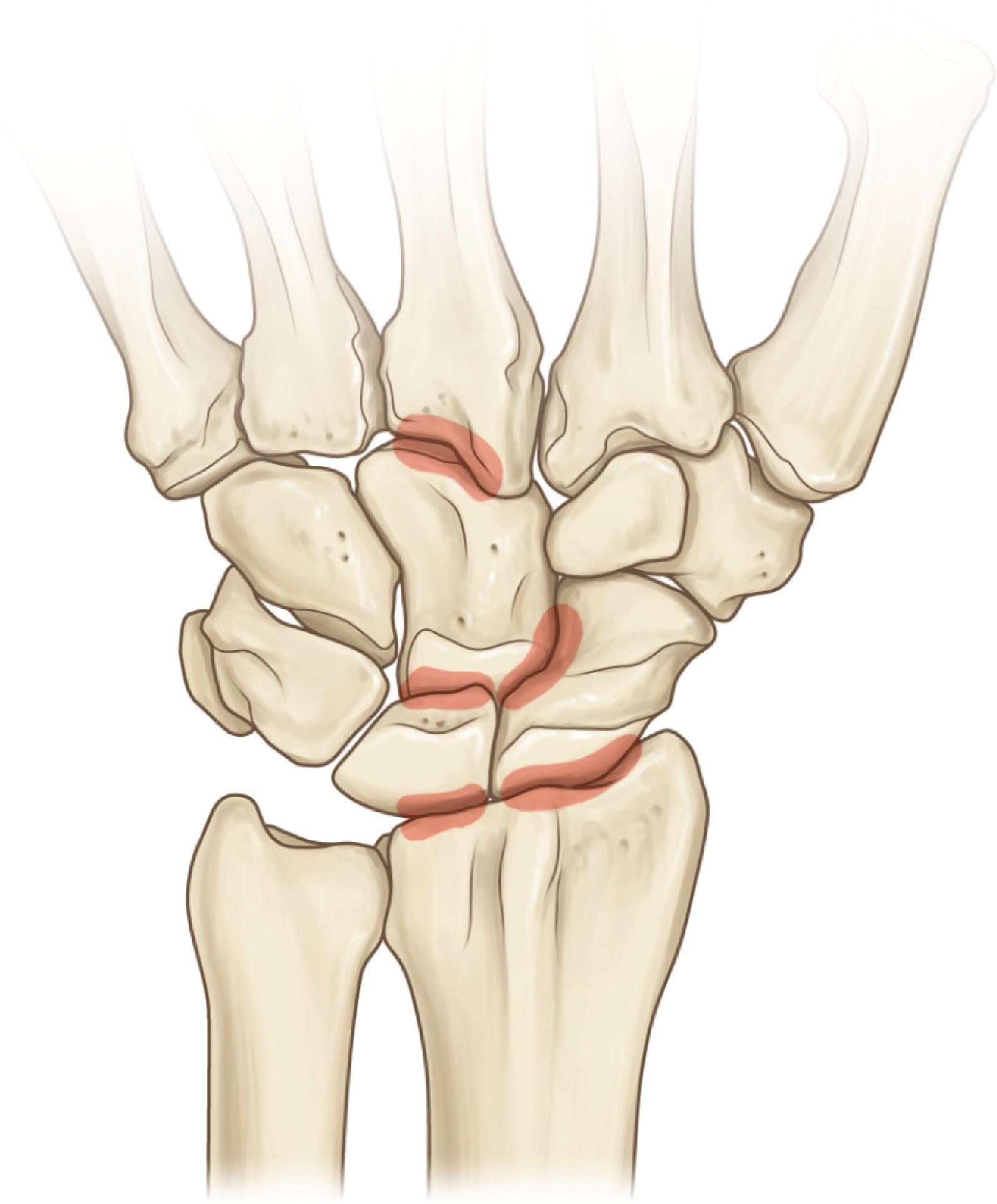 Figure 19.37, Shaded areas represent the articulations that should be prepared for a complete wrist arthrodesis.