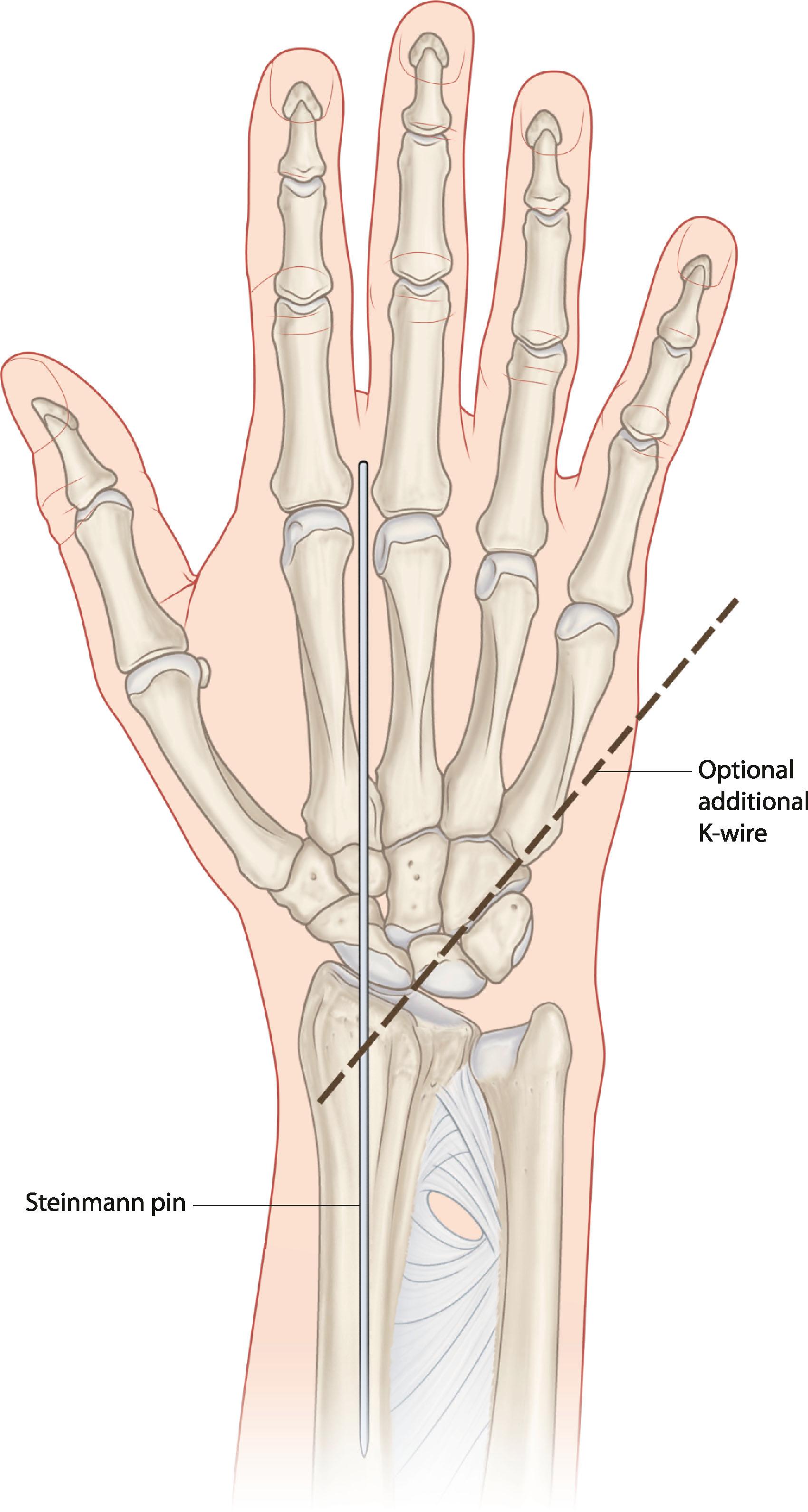 Figure 19.38, Wrist arthrodesis with a single Steinmann pin. The pin exits the carpus in the second intermetacarpal space, and is cut just below the skin for later removal. The oblique K-wire is optional.