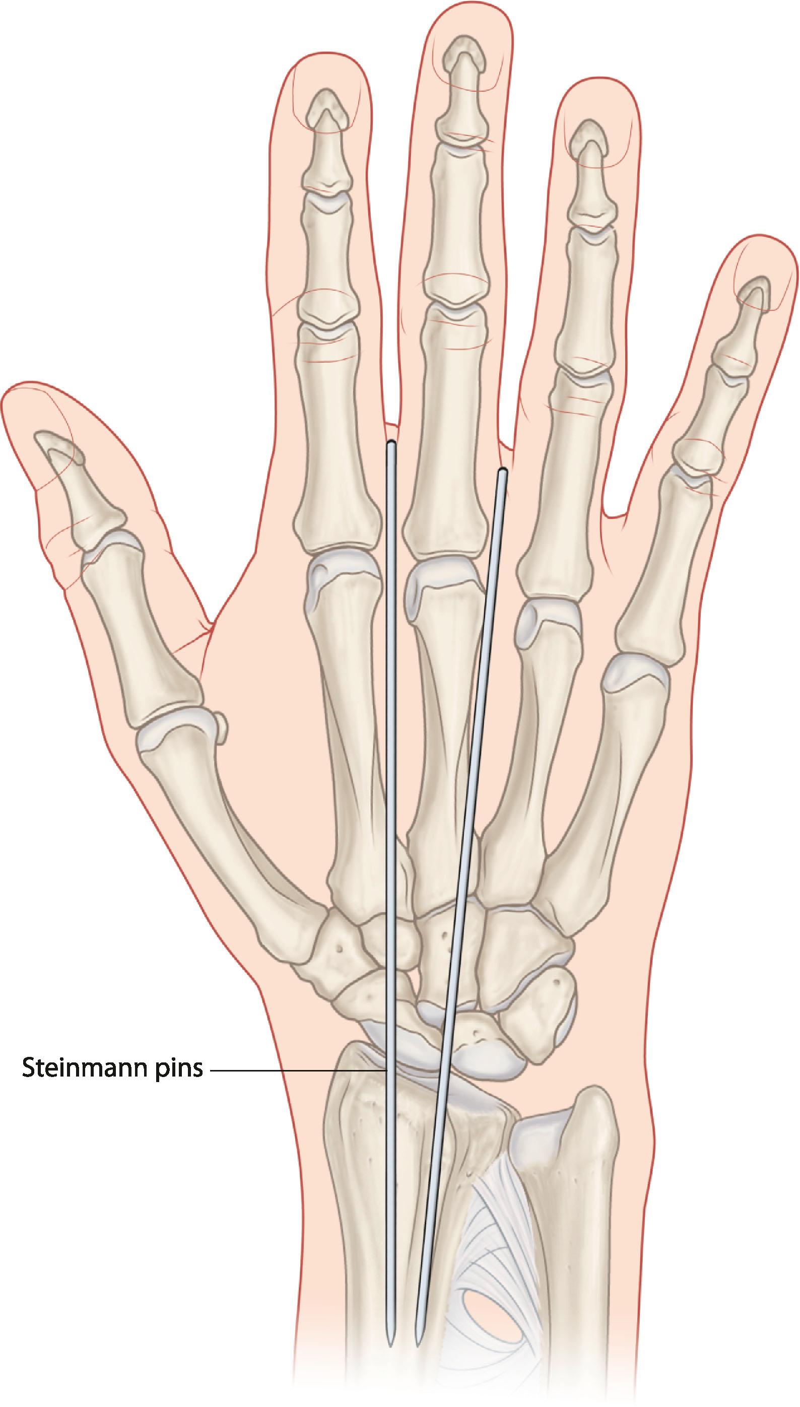 Figure 19.39, Wrist arthrodesis with two Steinmann pins. The pins exit the carpus in the second and 3rd intermetacarpal spaces, and are cut just below the skin for later removal.