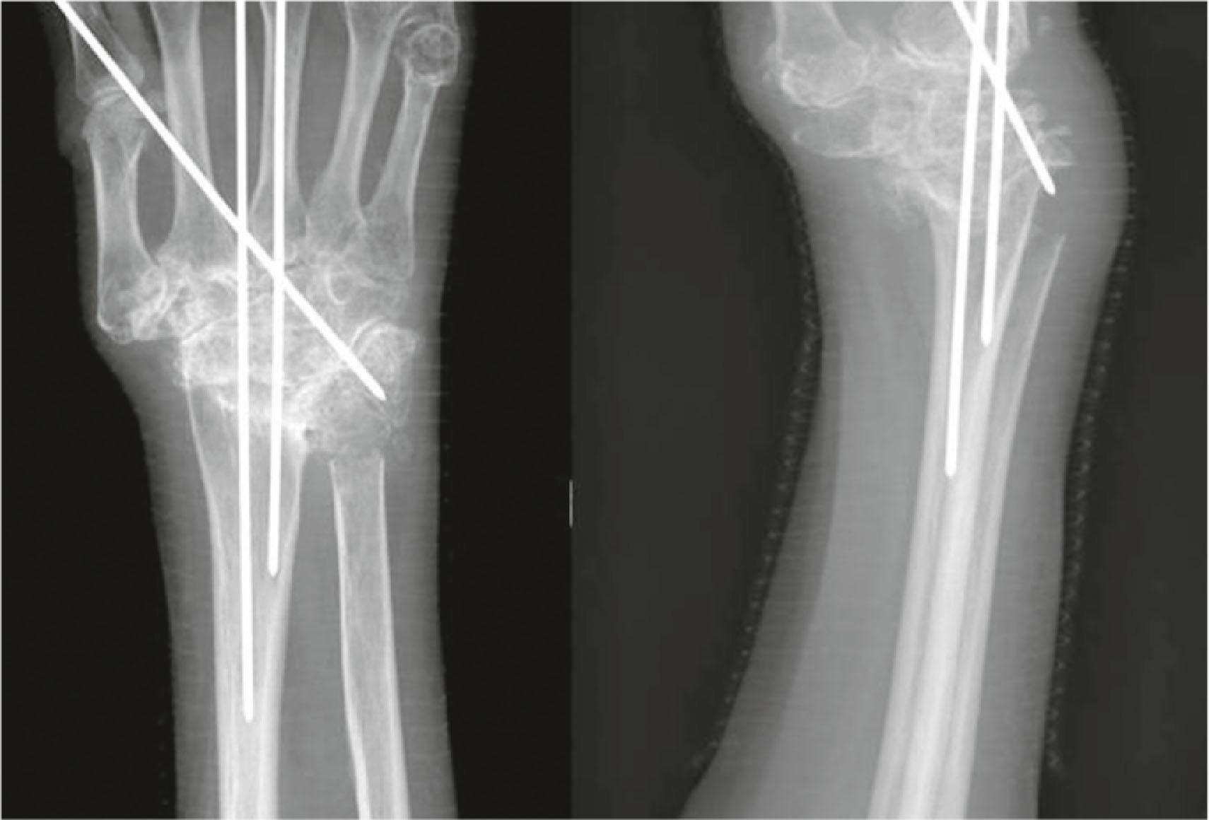 Figure 19.40, Wrist arthrodesis with two longitudinal Steinmann pins, and a third oblique pin for added fixation.