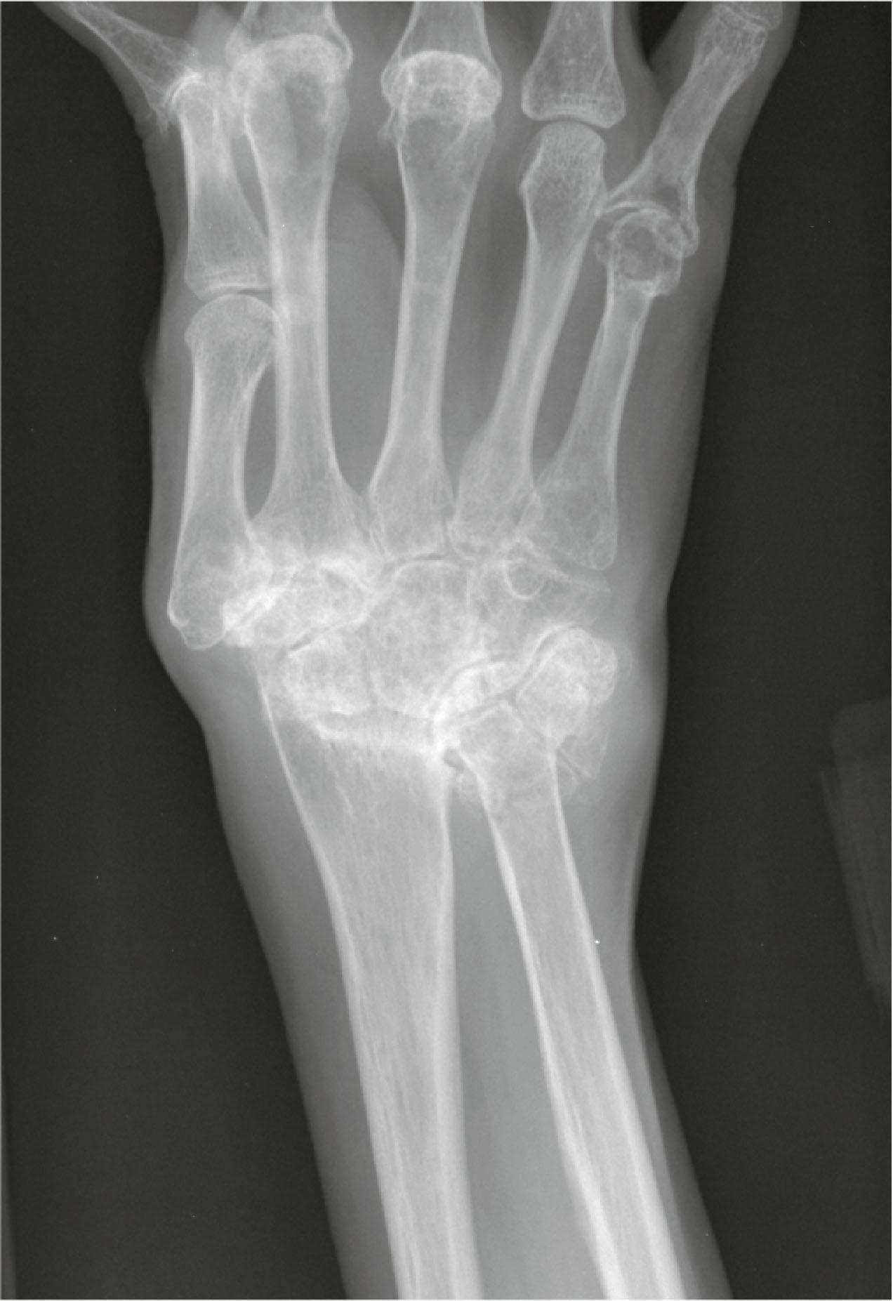 Figure 19.4, PA radiograph of the right wrist, demonstrating severe involvement of the wrist.