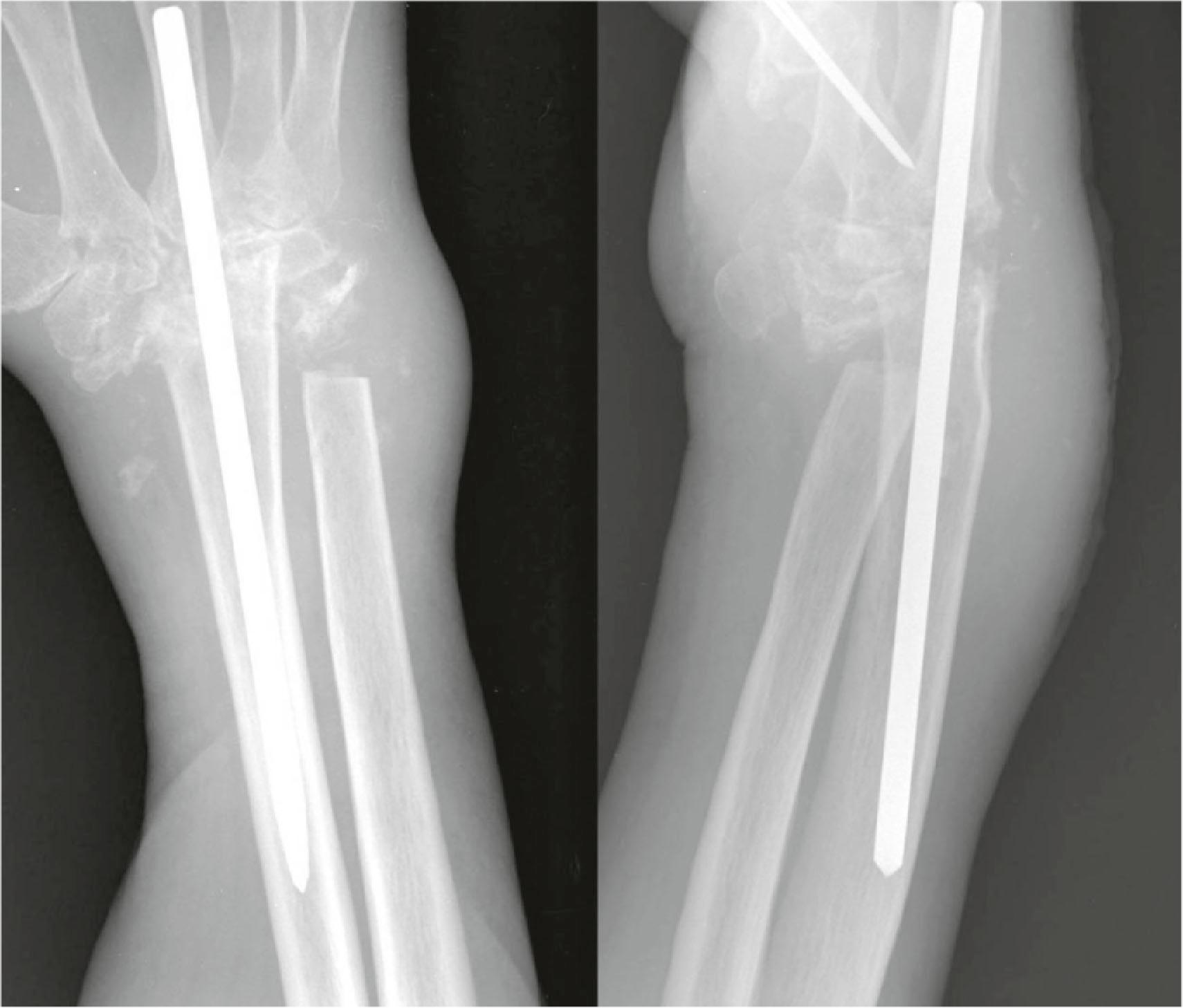 Figure 19.42, PA and lateral radiographs demonstrating wrist arthrodesis performed with a single intramedullary pin. Note the large caliber of pin required to fill the medullary canal of the radius.