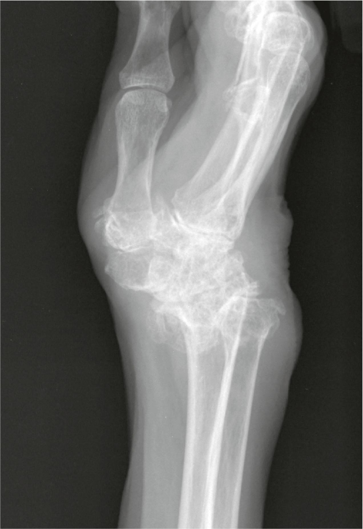 Figure 19.5, Lateral radiograph of the right wrist, demonstrating destruction of the volar lip of the radius, with volar subluxation of the carpus.