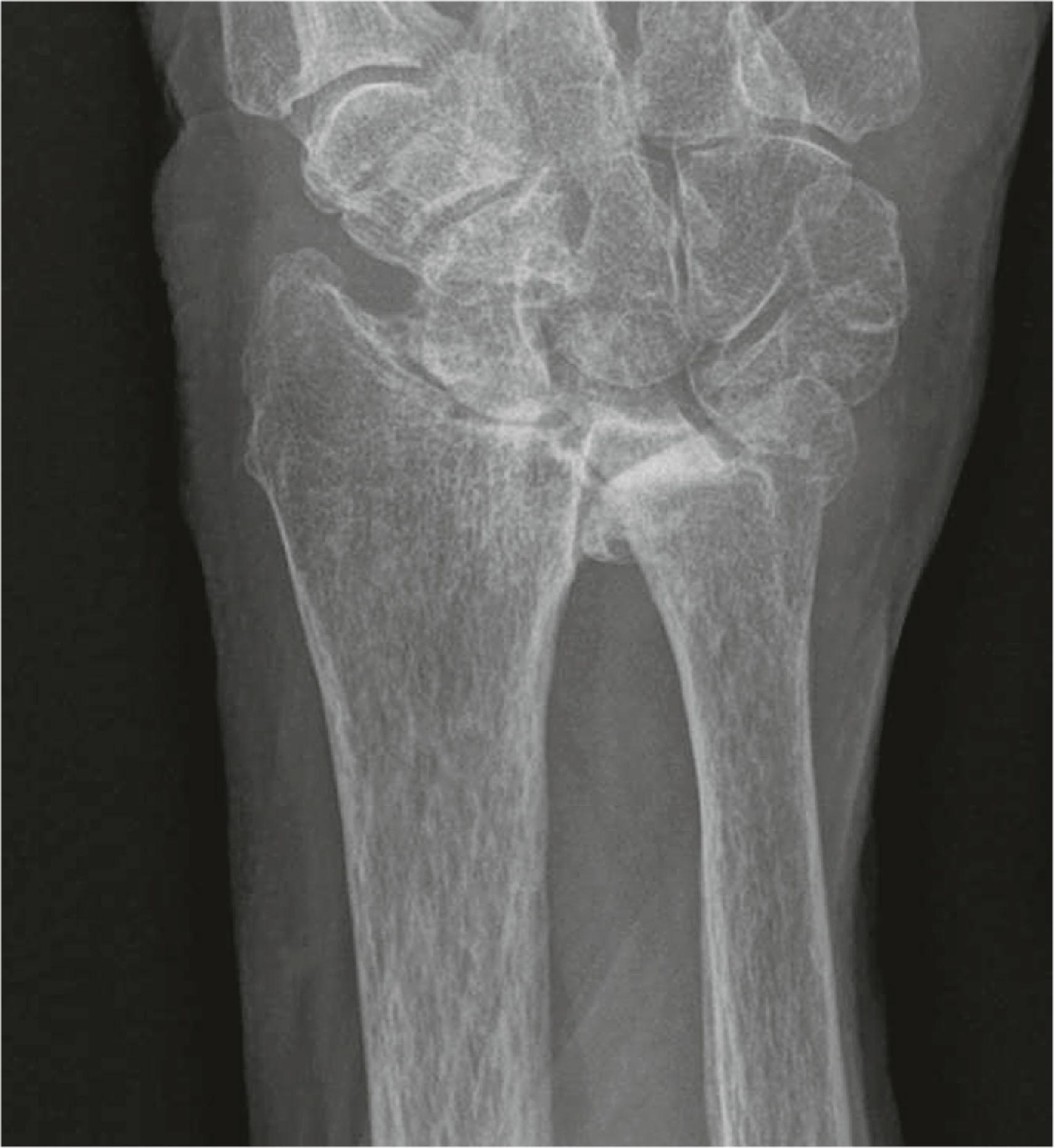 Figure 19.7, PA radiograph of the right wrist, demonstrating even more severe ulnar translocation, and relative preservation of the mid-carpal joint as compared to the radiocarpal joint.