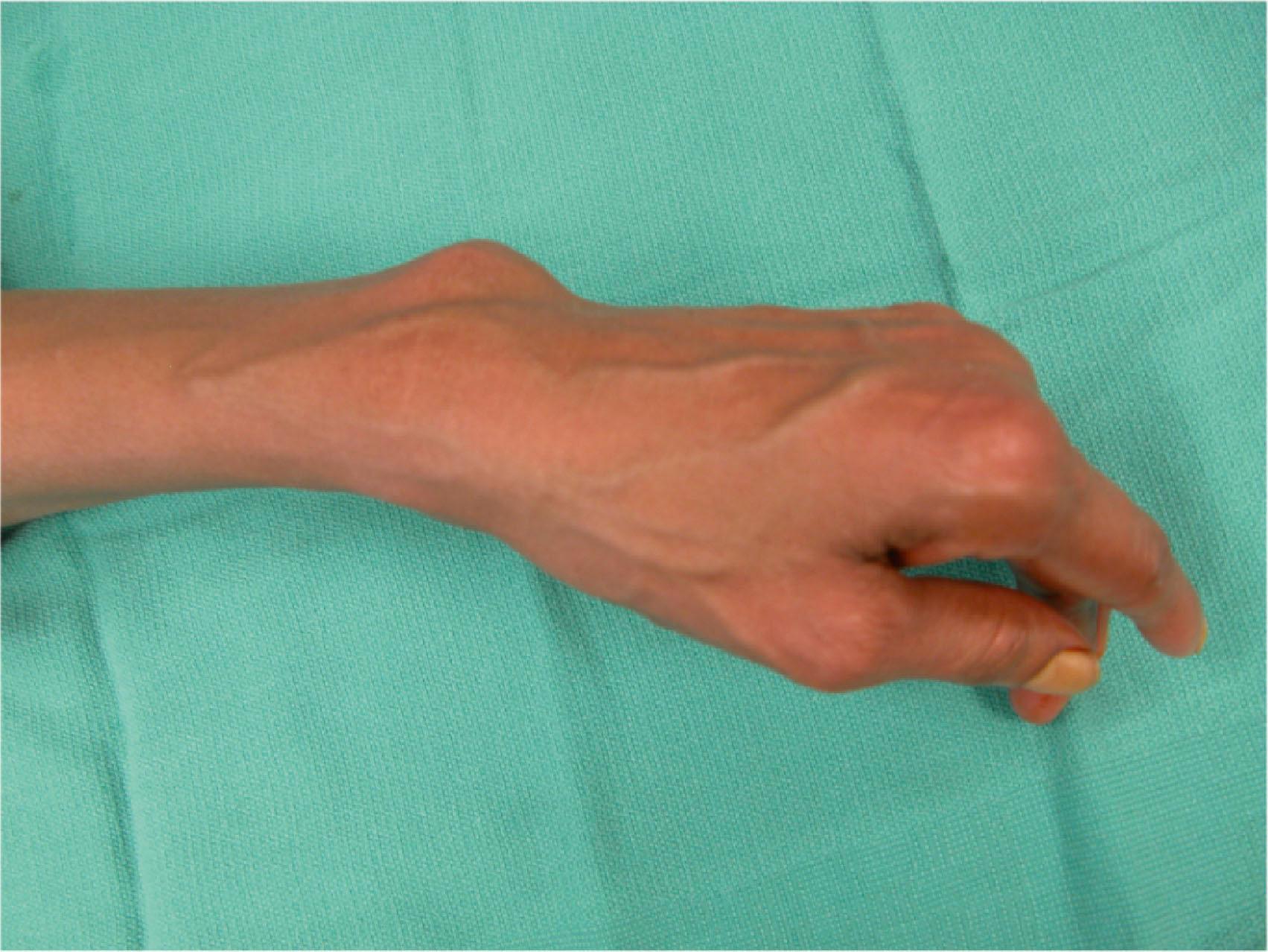 Figure 19.8, Caput ulnae, with dorsal dislocation of the ulnar head and carpal supination.