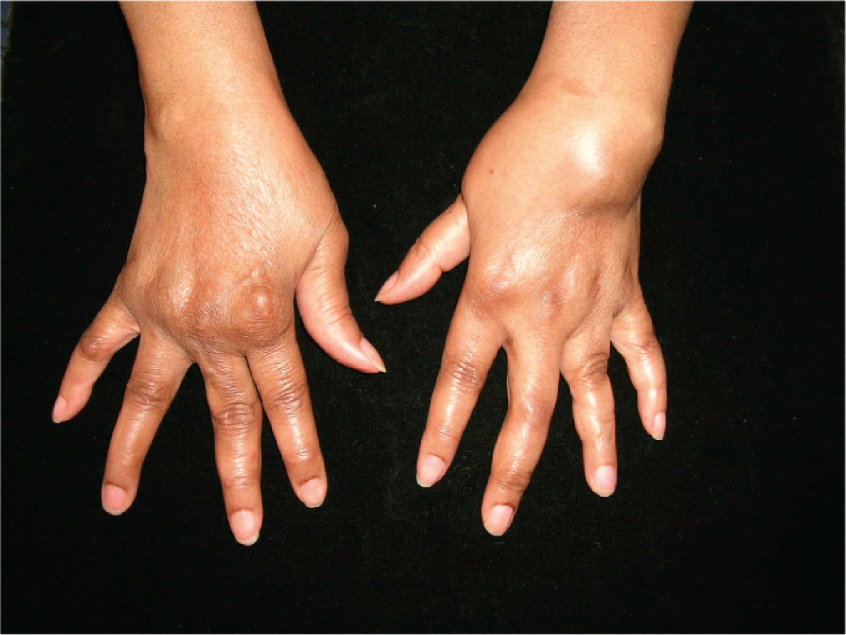 Figure 19.10, Extensor tensynovitis protruding from under the extensor retinaculum distally.