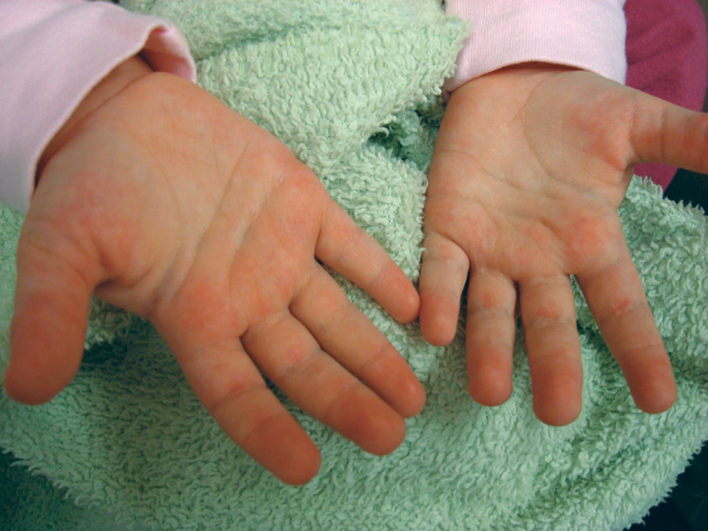 Fig. 7.12, Systemic lupus erythematosus. Palmar erythema.