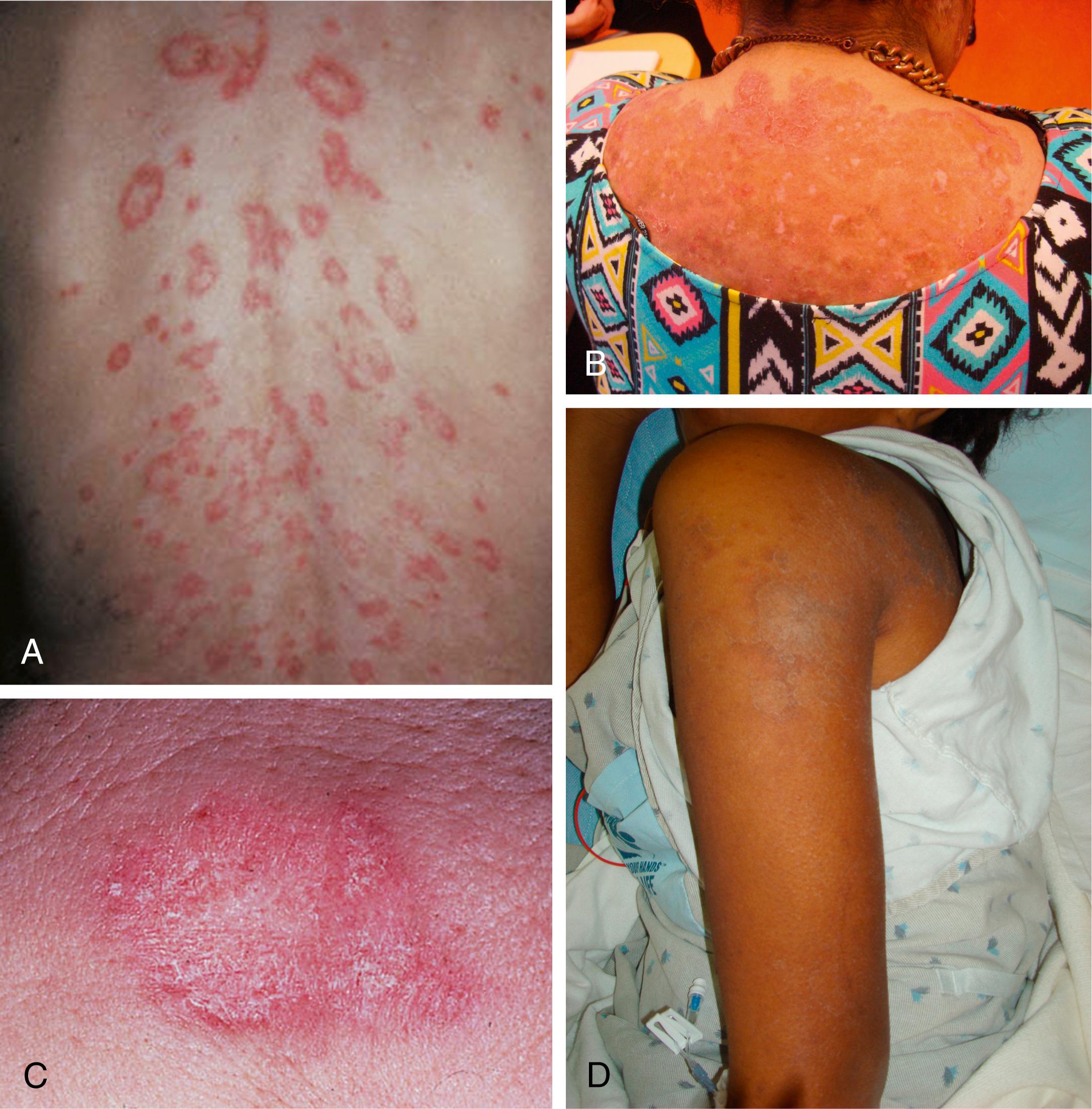 Fig. 7.13, Systemic lupus erythematosus (SLE). (A) Erythematous rash on trunk. (B) Significant postinflammatory hyperpigmentation may be present as well. (C and D) The rash of SLE often has a slight white scale.