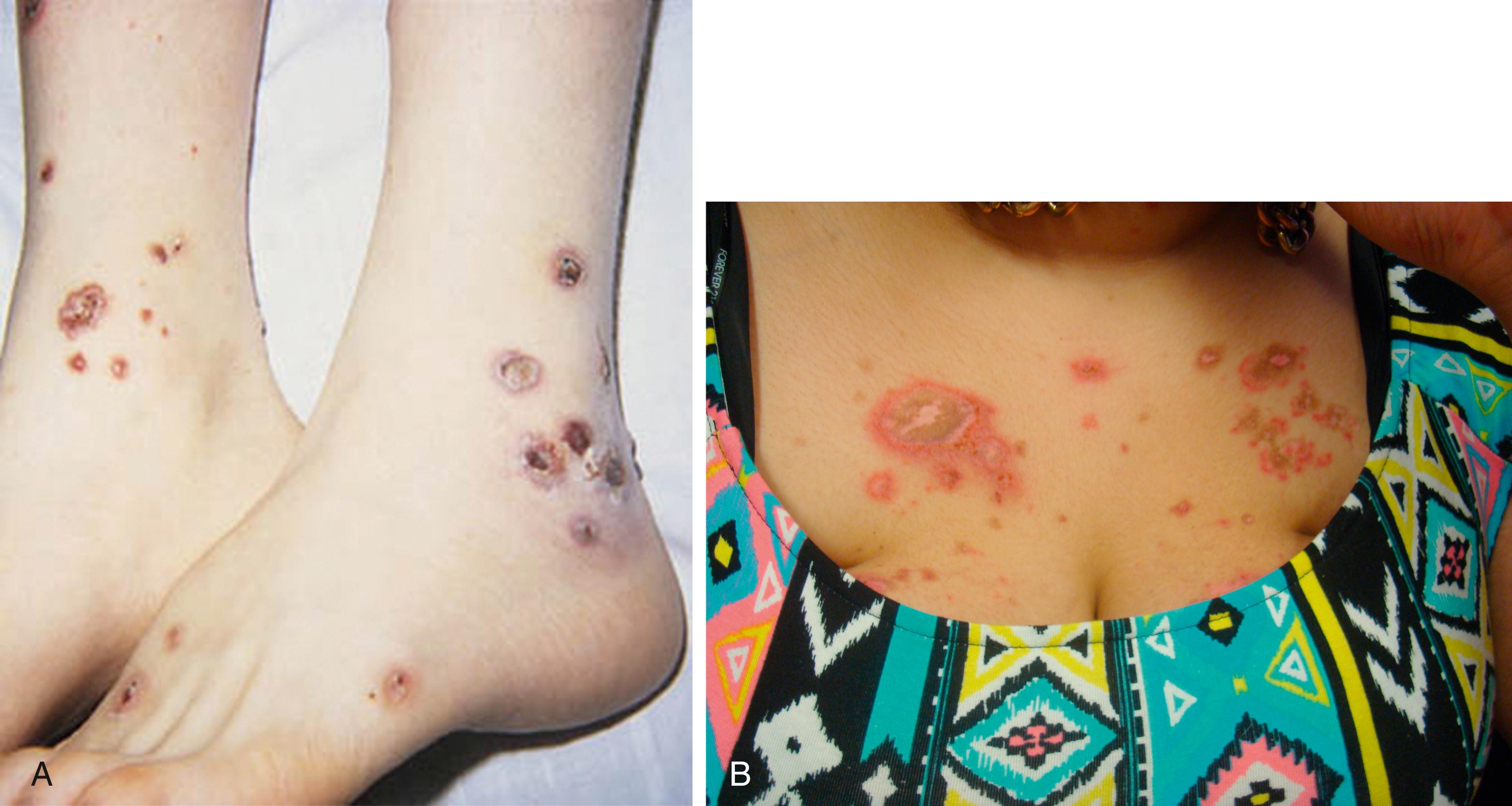 Fig. 7.14, Systemic lupus erythematosus. Purpuric, ulcerative, and necrotic skin lesions of cutaneous vasculitis may be found acrally (A) or centrally (B).