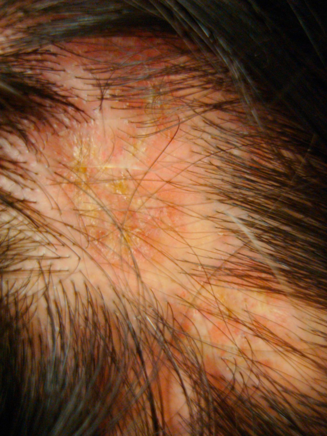 Fig. 7.16, Systemic lupus erythematosus. Scarring alopecia.