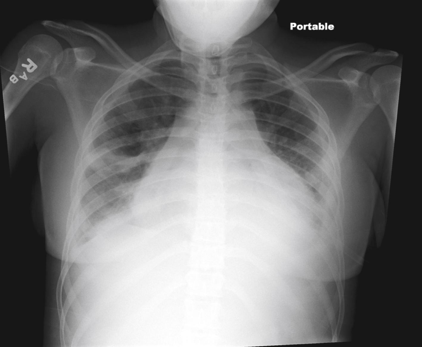 Fig. 7.17, Systemic lupus erythematosus. Large pericardial effusion with associated cardiac tamponade physiology in teenage female. Pleural effusions are also present.