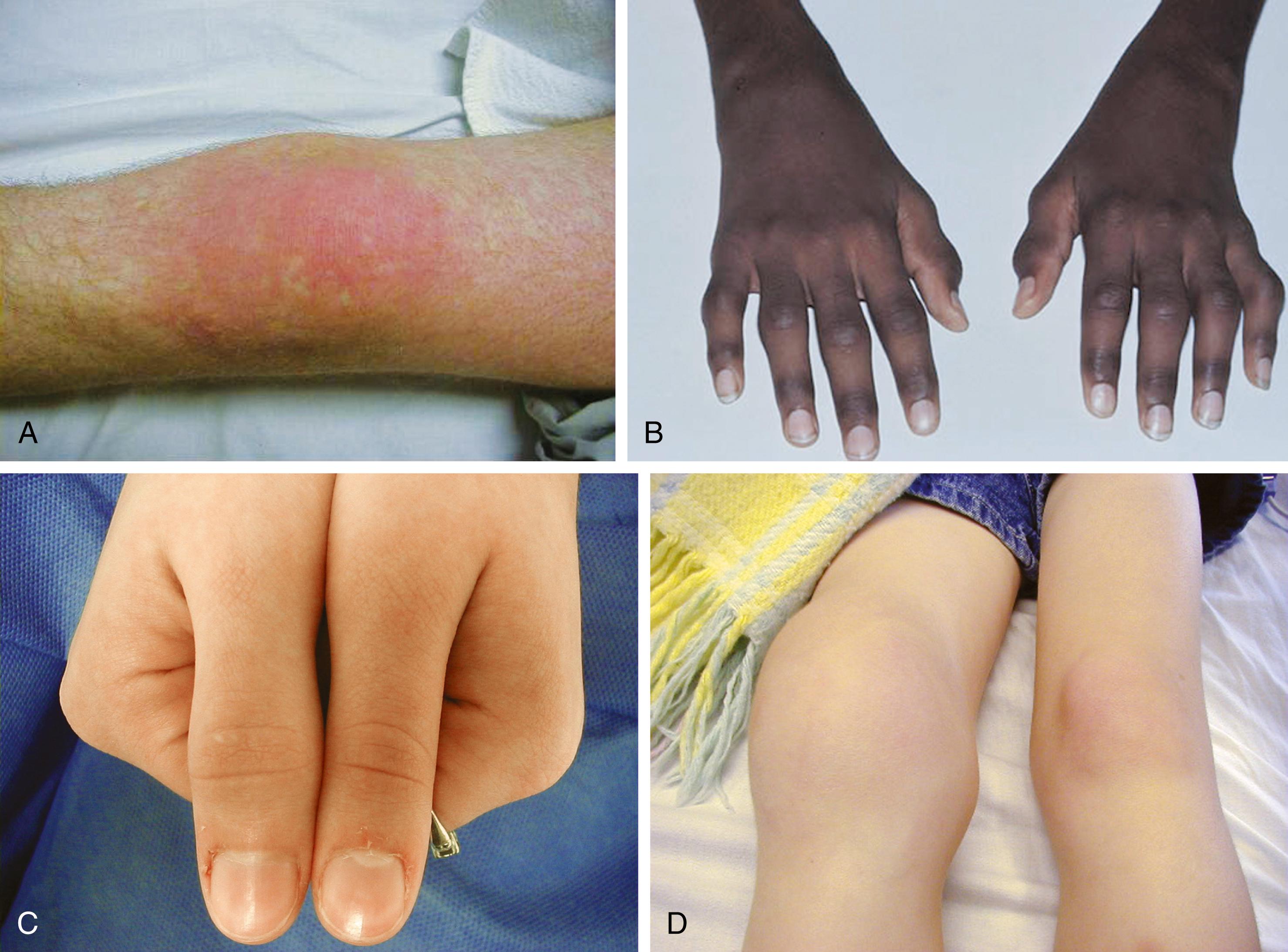 Fig. 7.3, Juvenile idiopathic arthritis. (A) Erythema of the knee in a patient with systemic-onset juvenile idiopathic arthritis (JIA) (Still disease). (B) Swelling and inflammation of the small joints of the hands in a patient with polyarticular JIA. Note the inability to fully extend the fingers. (C) Swelling of the right thumb interphalangeal joint. (D) Right knee swelling in a patient with oligoarticular JIA.