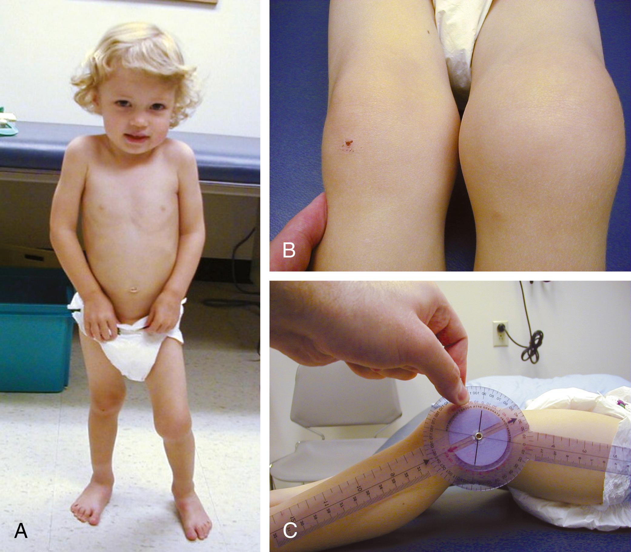 Fig. 7.4, Oligoarticular juvenile idiopathic arthritis. (A) A 2-year-old girl with arthritis of the left knee. Note that the left lower extremity is bent at the knee as she bears weight on the extended right lower extremity. (B) A closer look at the knees reveals left knee swelling. (C) The left knee can be extended only to 35 degrees (secondary to a flexion contracture).