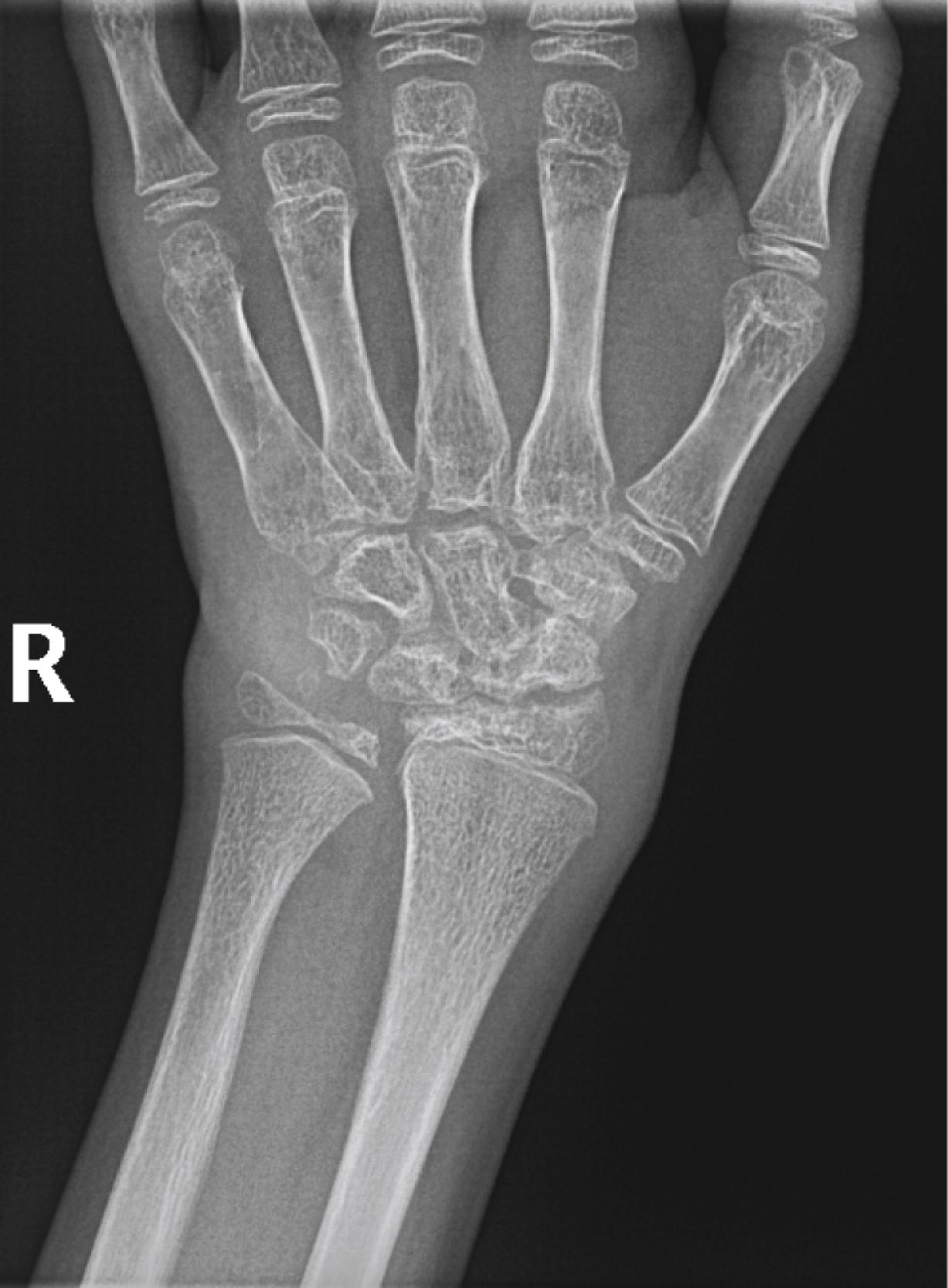 Fig. 7.5, Juvenile idiopathic arthritis. Diffuse demineralization with irregular joint space loss and sclerotic margination of the carpal bones and distal radius in an 8-year-old with chronic polyarticular juvenile idiopathic arthritis.