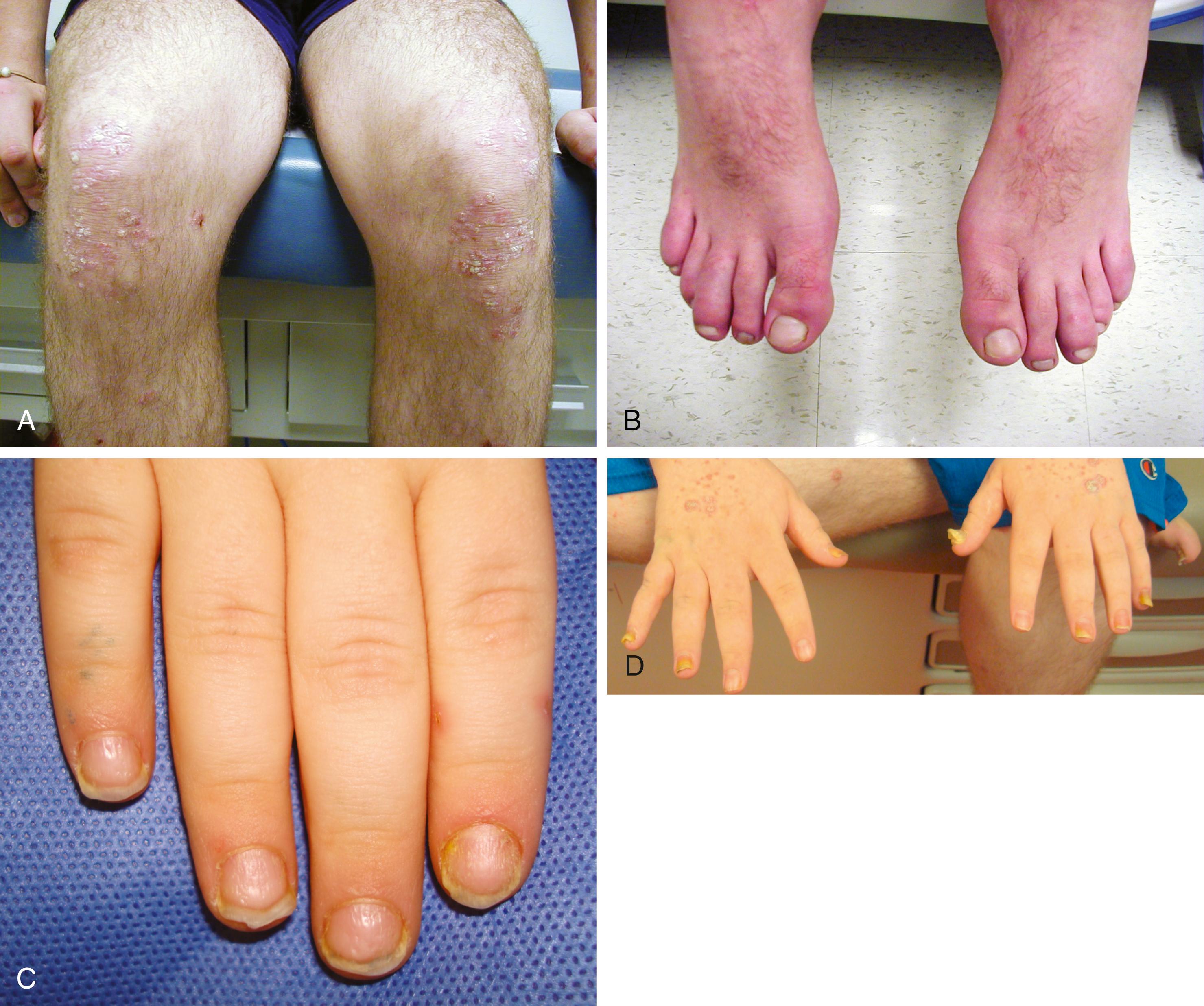 Fig. 7.6, Psoriatic arthritis. (A) Erythematous plaques with silver scale. (B) Dactylitis (sausage toe) of the bilateral third and fifth toes. (C) Diffuse nail pitting. (D) Diffuse onycholysis.