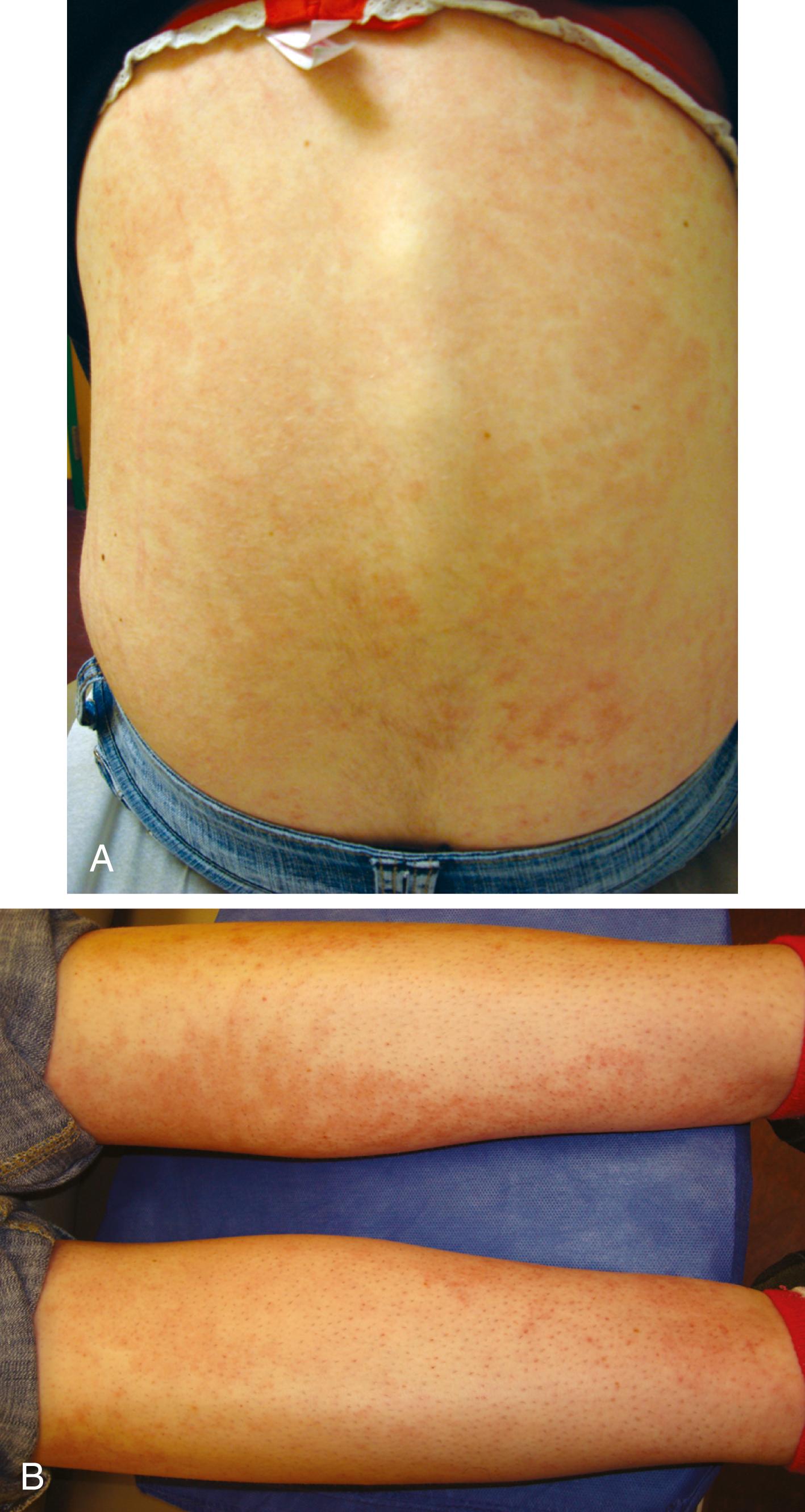 Fig. 7.7, Systemic juvenile idiopathic arthritis. (A and B) The rash is erythematous, macular, and often evanescent. It can be more prominent during periods of fever. Featured on trunk and extremities.