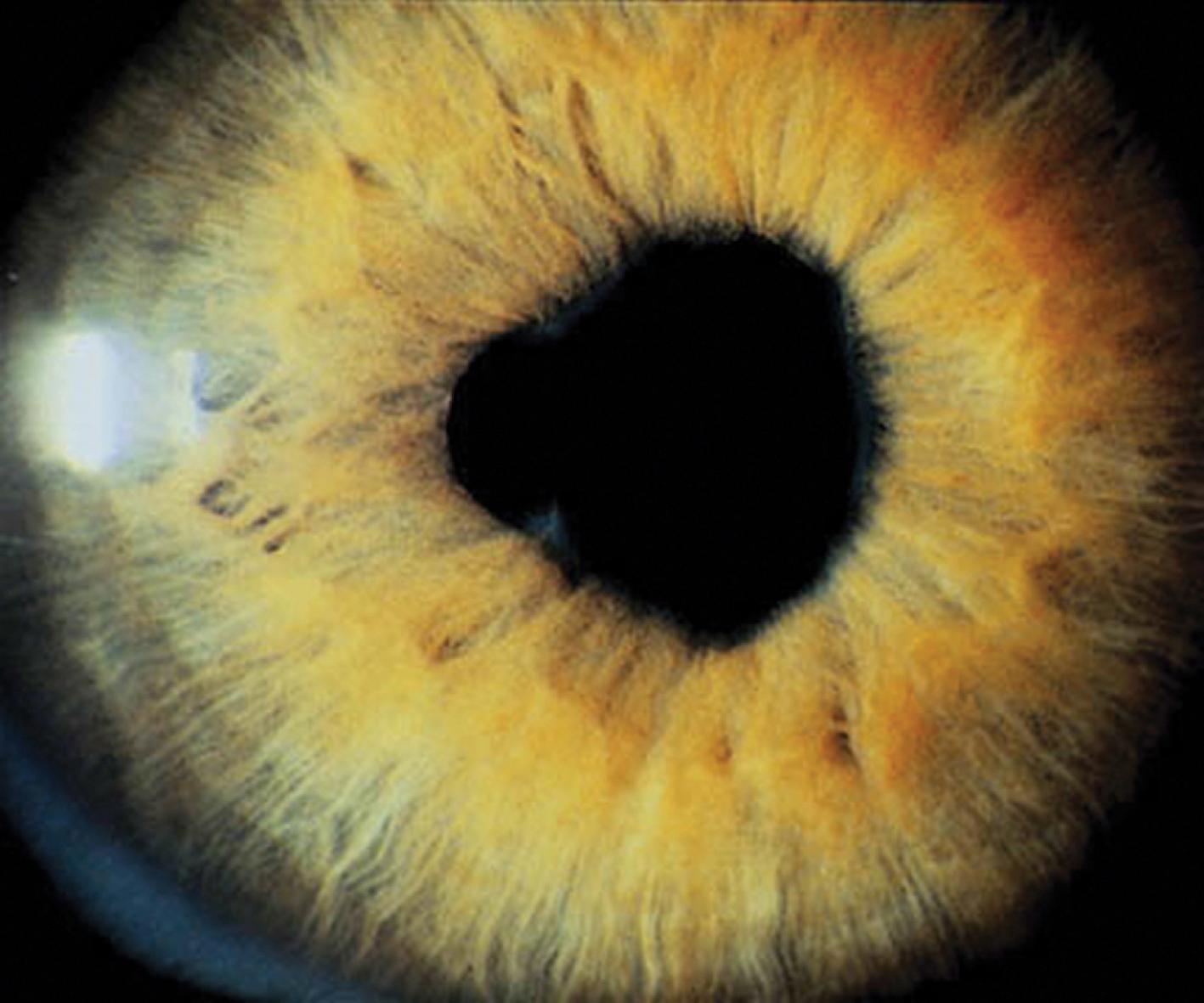 Fig. 7.8, Iridocyclitis. An irregular pupil in a patient with oligoarticular juvenile idiopathic arthritis. Note synechiae projecting posteriorly toward the lens.