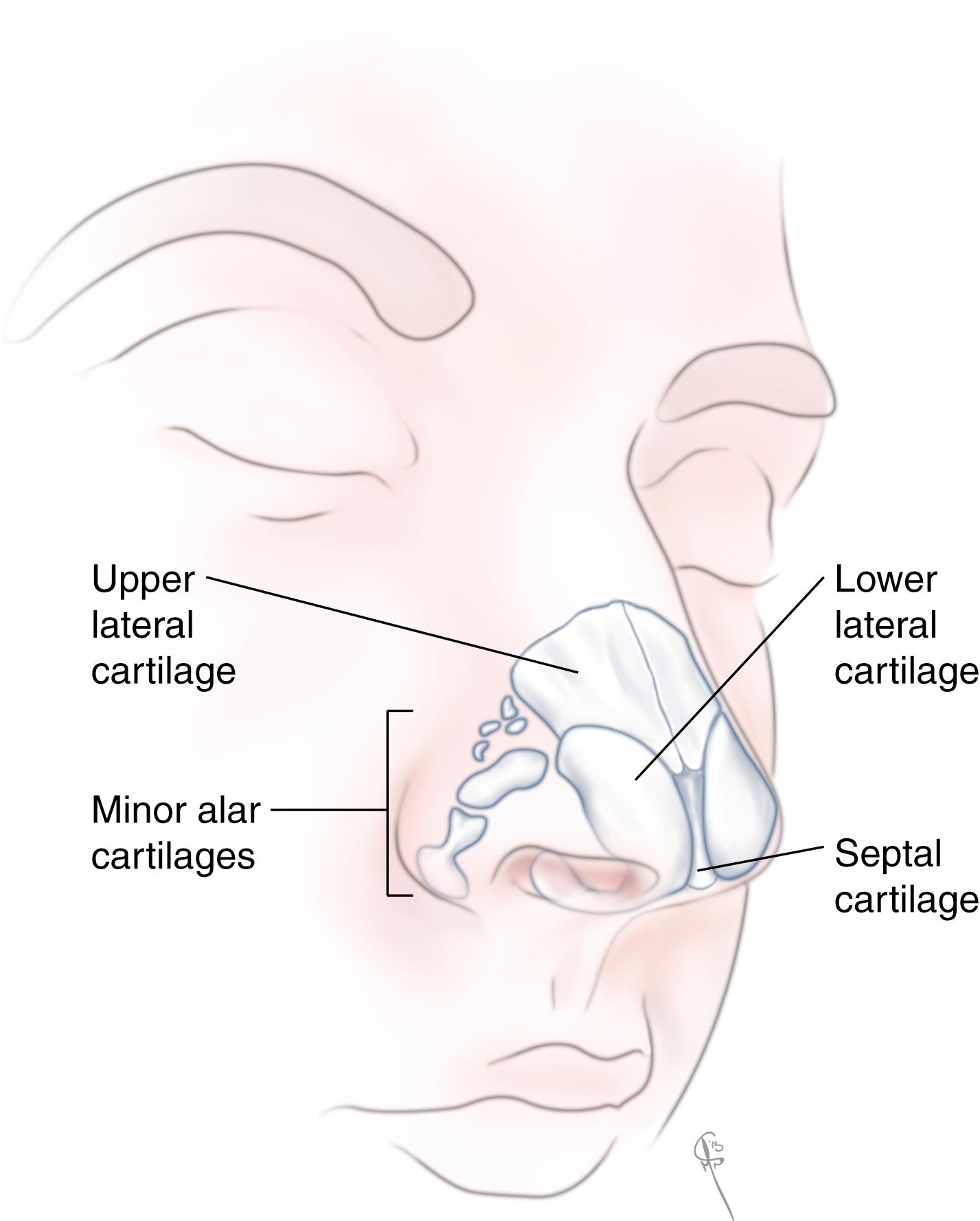 Fig. 68.1, The cartilaginous components of the nose in relation to surface anatomy.