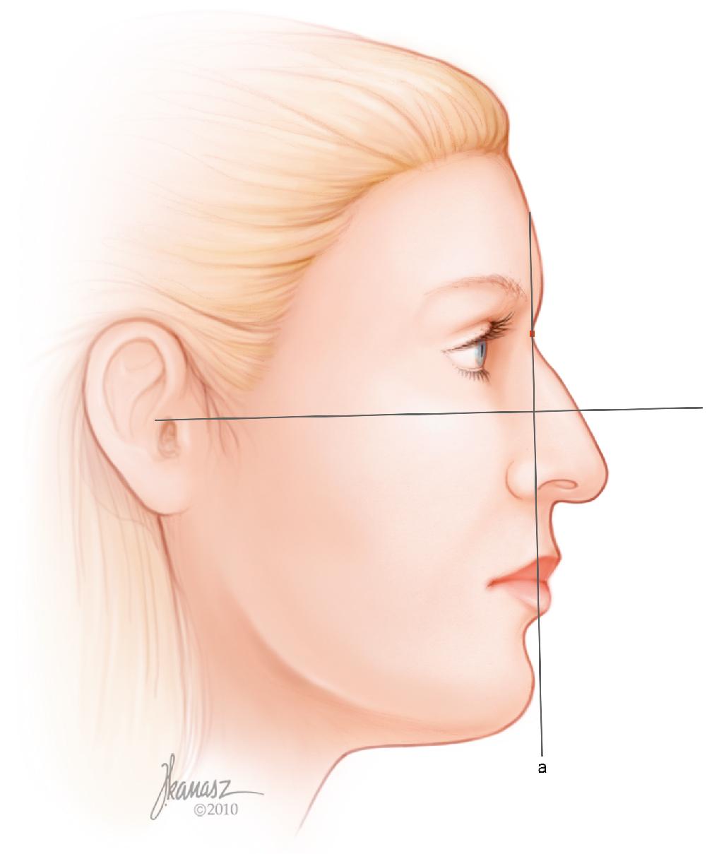 Fig. 28.12, A line is dropped from the radix in a 90-degree relation to the Frankfort horizontal line. This will define the vertical facial plane ( line a ).