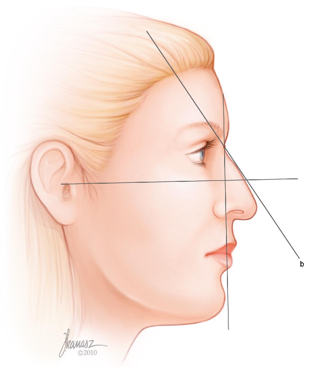 Fig. 28.13, From the radix, the dorsum is drawn in relation to the vertical facial plane at a 34-degree angle for a female and a 36-degree angle for a male ( line b ).