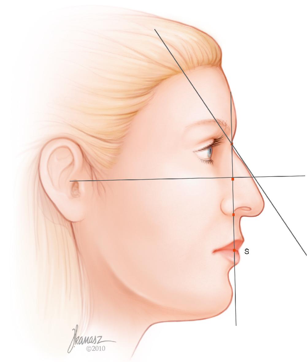 Fig. 28.14, The distance between the radix or medial canthus and the stomion (upper and lower lip junction; point S ) is measured and divided into three equal segments.