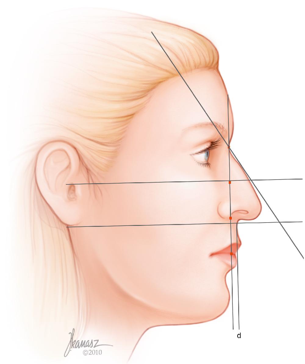 Fig. 28.16, The most projected portion of the upper lip (labrale superius) is marked. A vertical line is drawn 1 to 2 mm behind this point parallel to the vertical facial plane ( line d ).