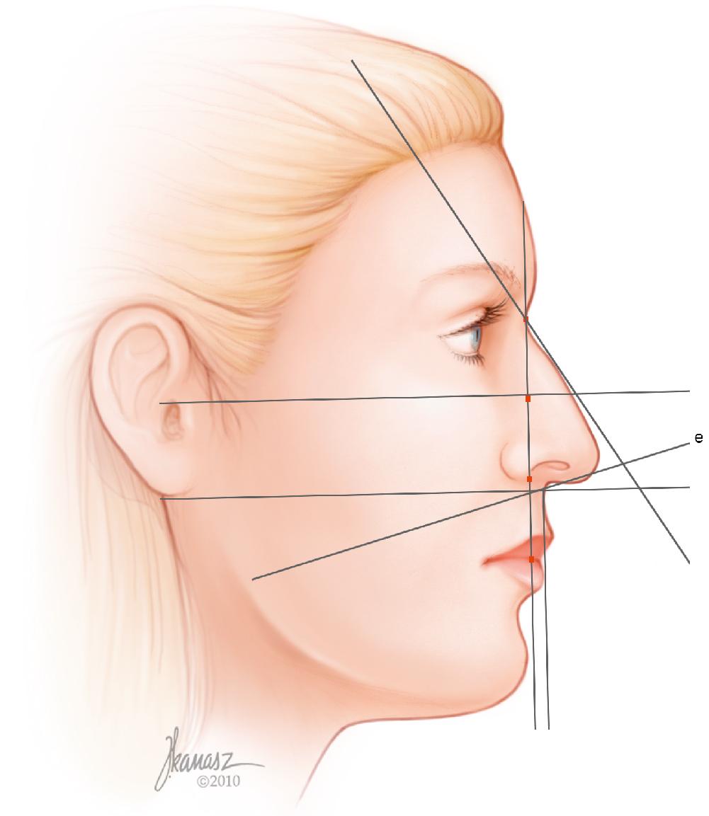 Fig. 28.17, The subnasale is located at the point of intersection of this line with the previous horizontal line shown in Figure 28.15 . A line is projected from the subnasale at a 98- to 108-degree angle for a female and a 95- to 98-degree angle for a male in relation to the vertical line to construct the nasolabial angle ( line e ). We now have a triangular nasal frame within which the nasal profile can be drawn with pleasing proportions.