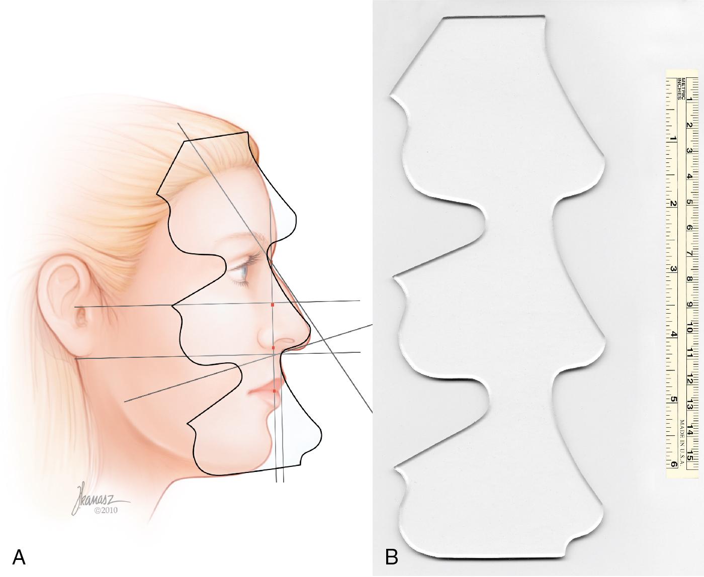 Fig. 28.18, (A, B) The prefabricated nose template is used to create the nasal outline.