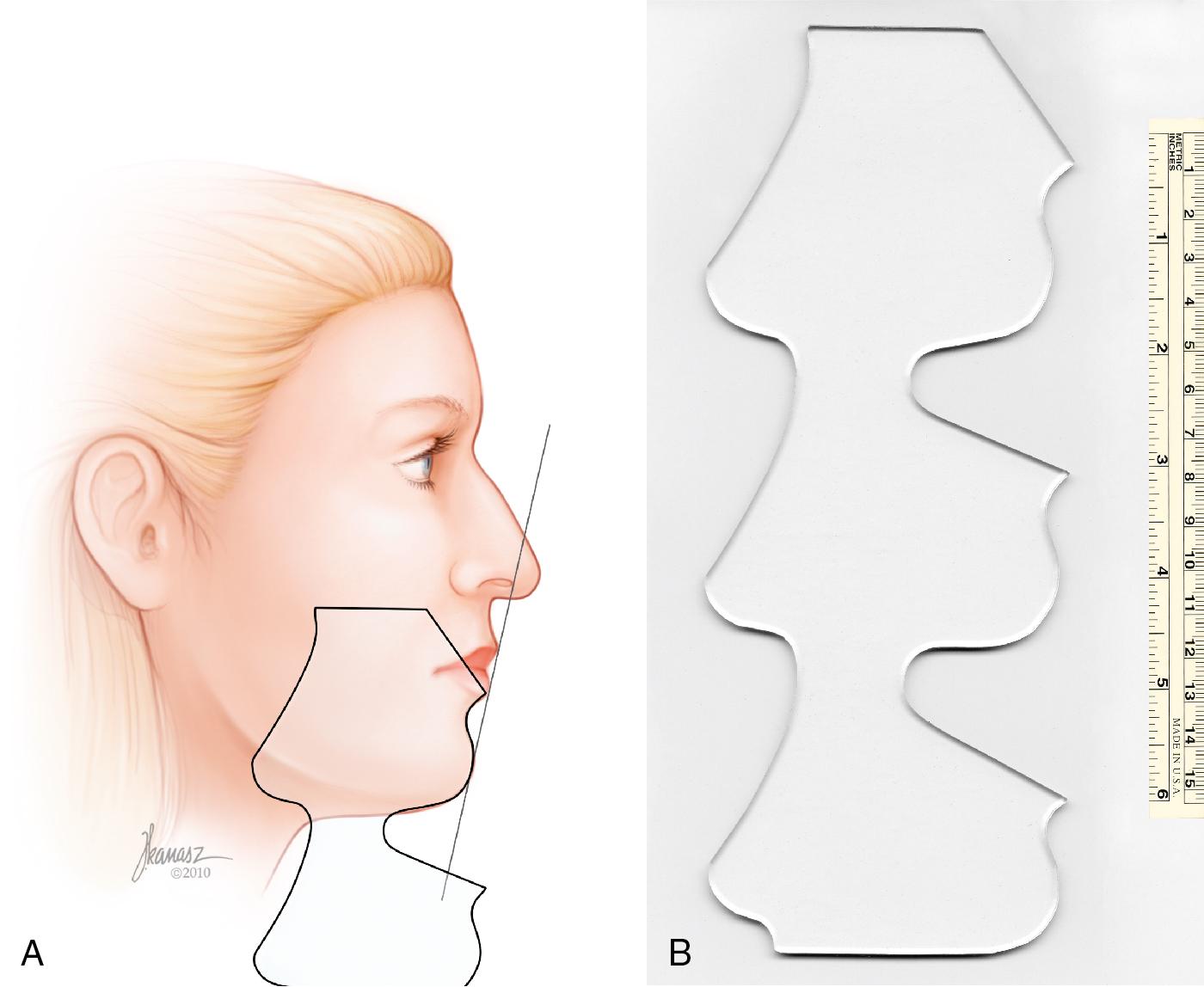 Fig. 28.19, (A, B) The most prominent portion of the upper lip is connected to the most prominent portion of the lower lip and continued. This line (Reidel’s line) usually touches the most prominent portion of the chin (pogonion). If the chin recedes, the chin template is used to draw a proper labiomental groove and chin prominence. The labiomental groove is usually 3 to 4 mm deep in a female and 4 to 5 mm deep in a male.