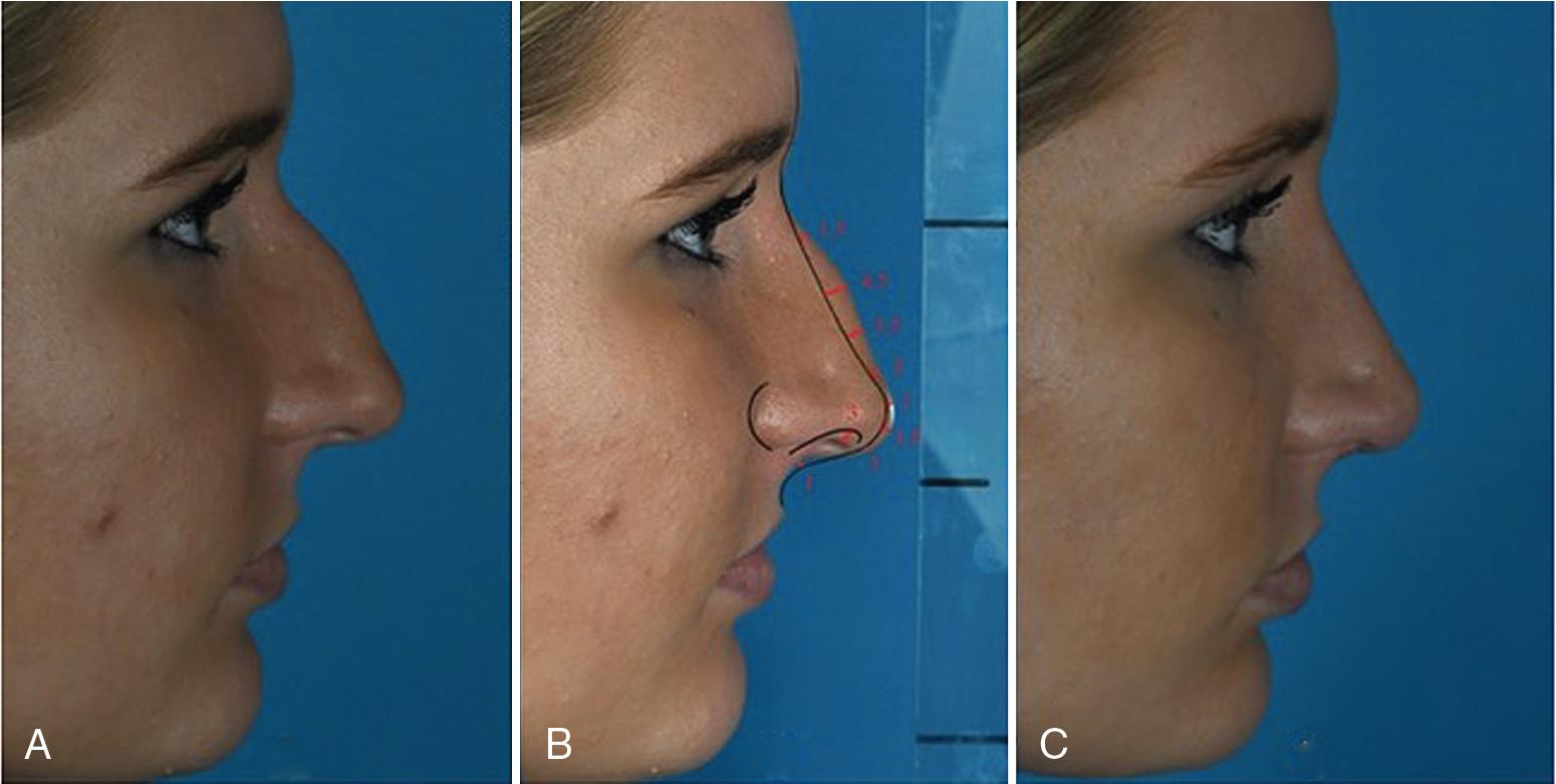 Fig. 28.10, (A, B, D, E) Preoperative photographs and life-size analysis of the patient. (C, F) Postoperative photographs of the same patient who had undergone surgery based on life size analysis findings.